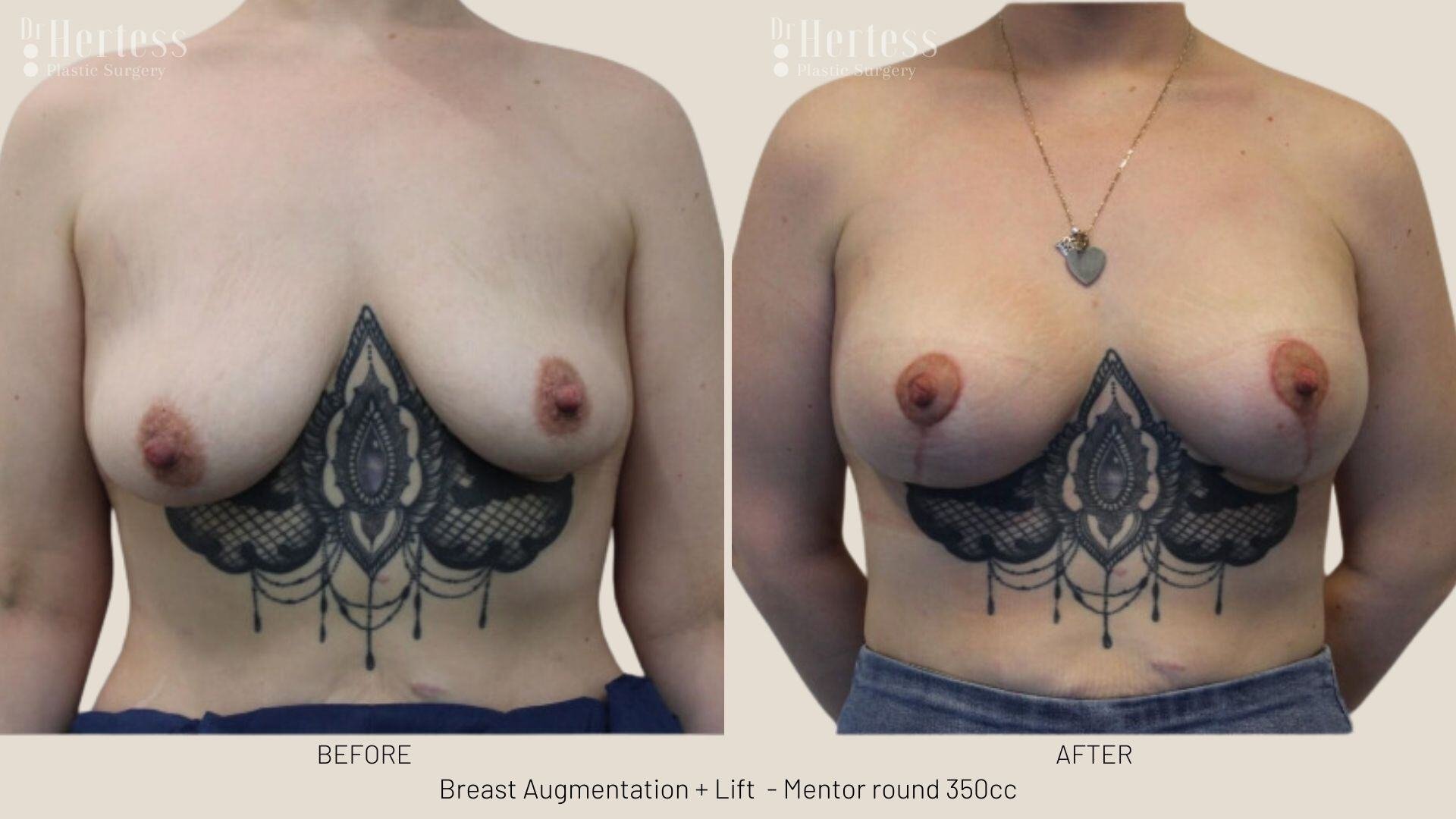breast implants and lift photos before and after