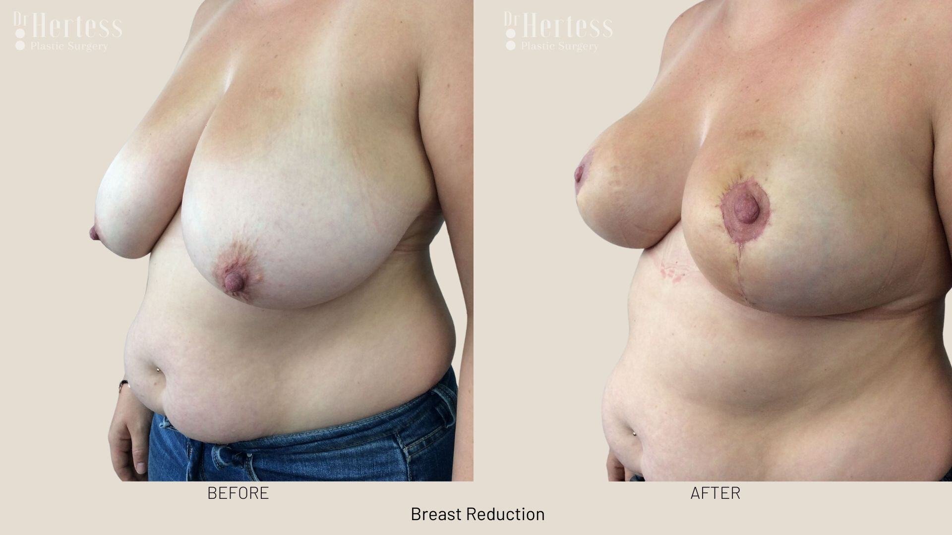 breast reduction before and after