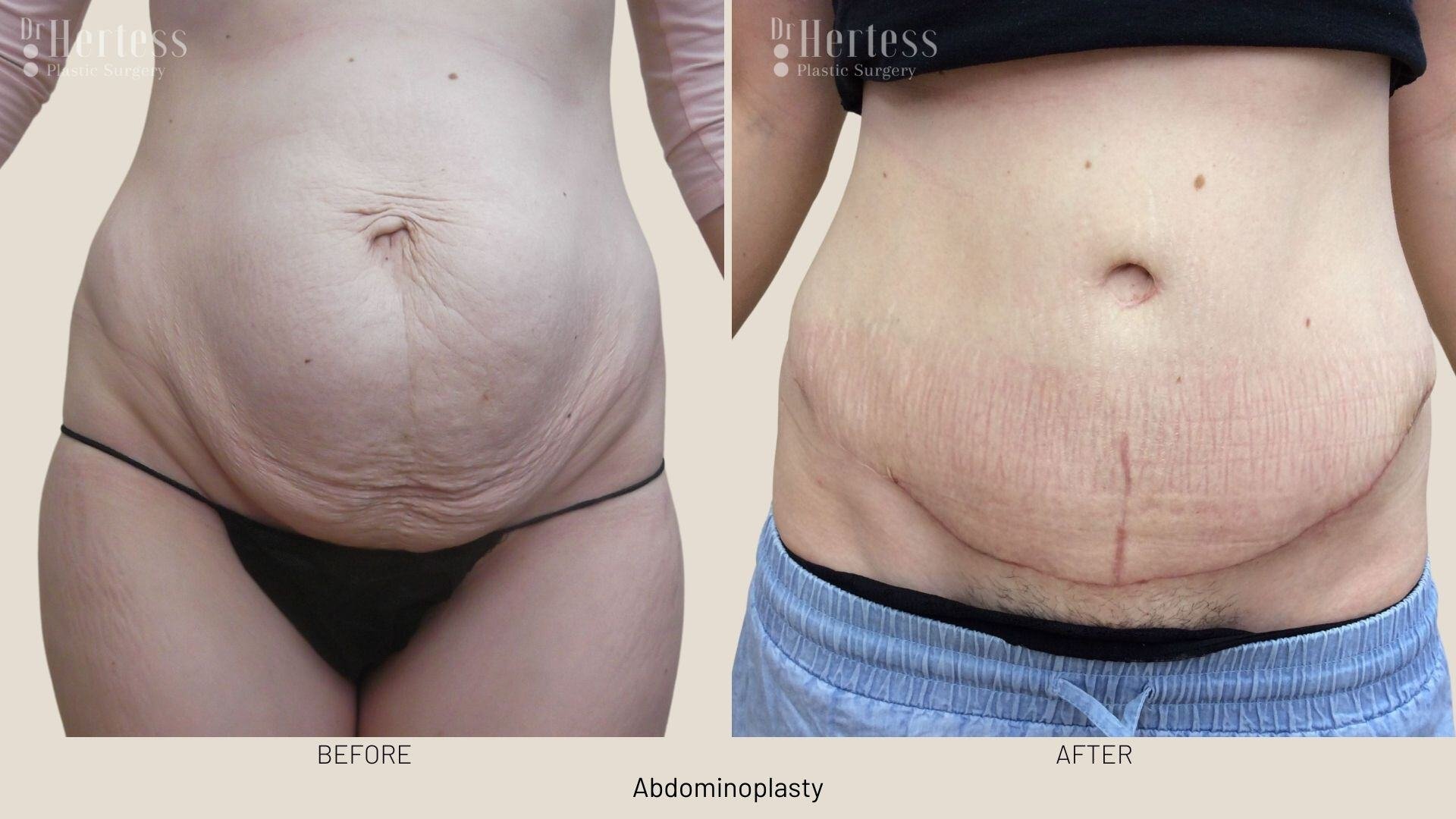 abdominoplasty before and after photos