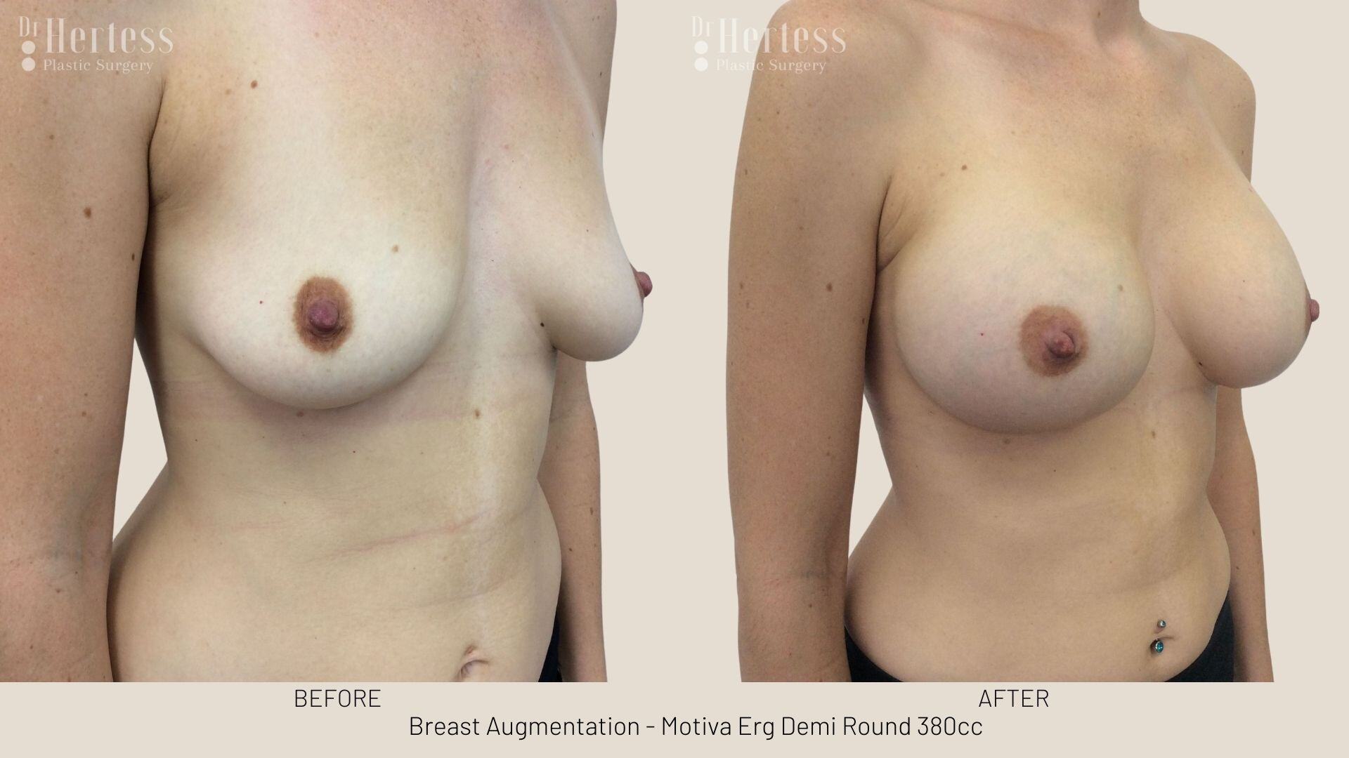breast implants before and after