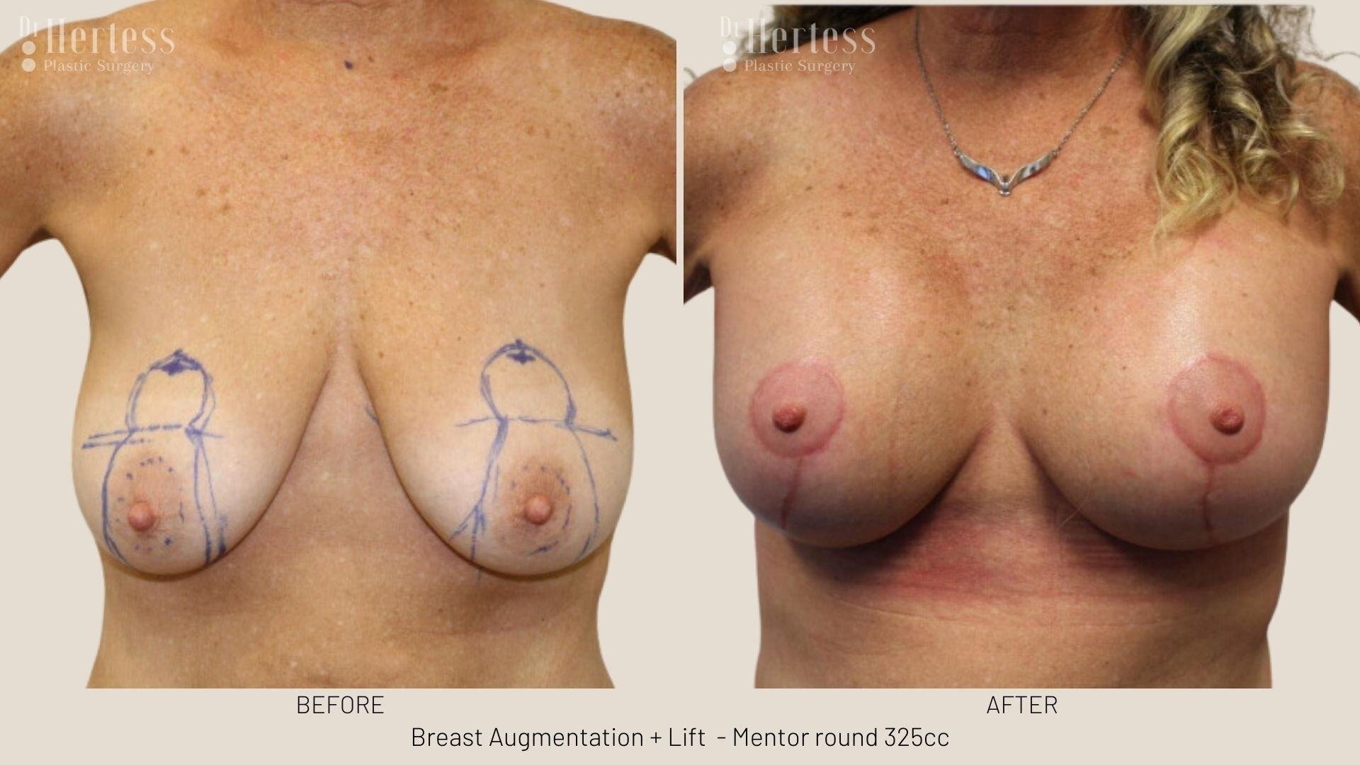 breast implants and lift photos before and after