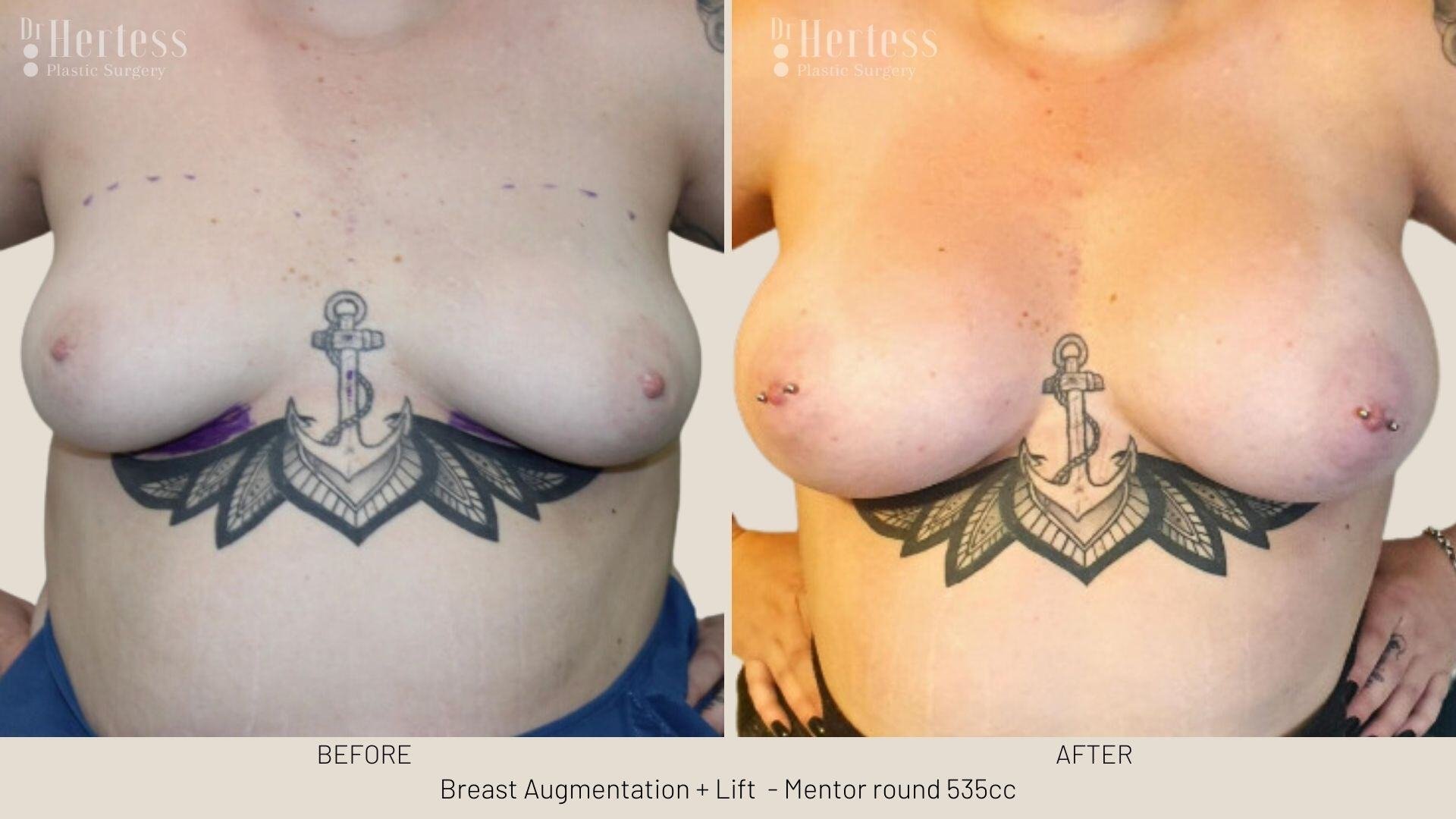breast implants and lift photos before and after