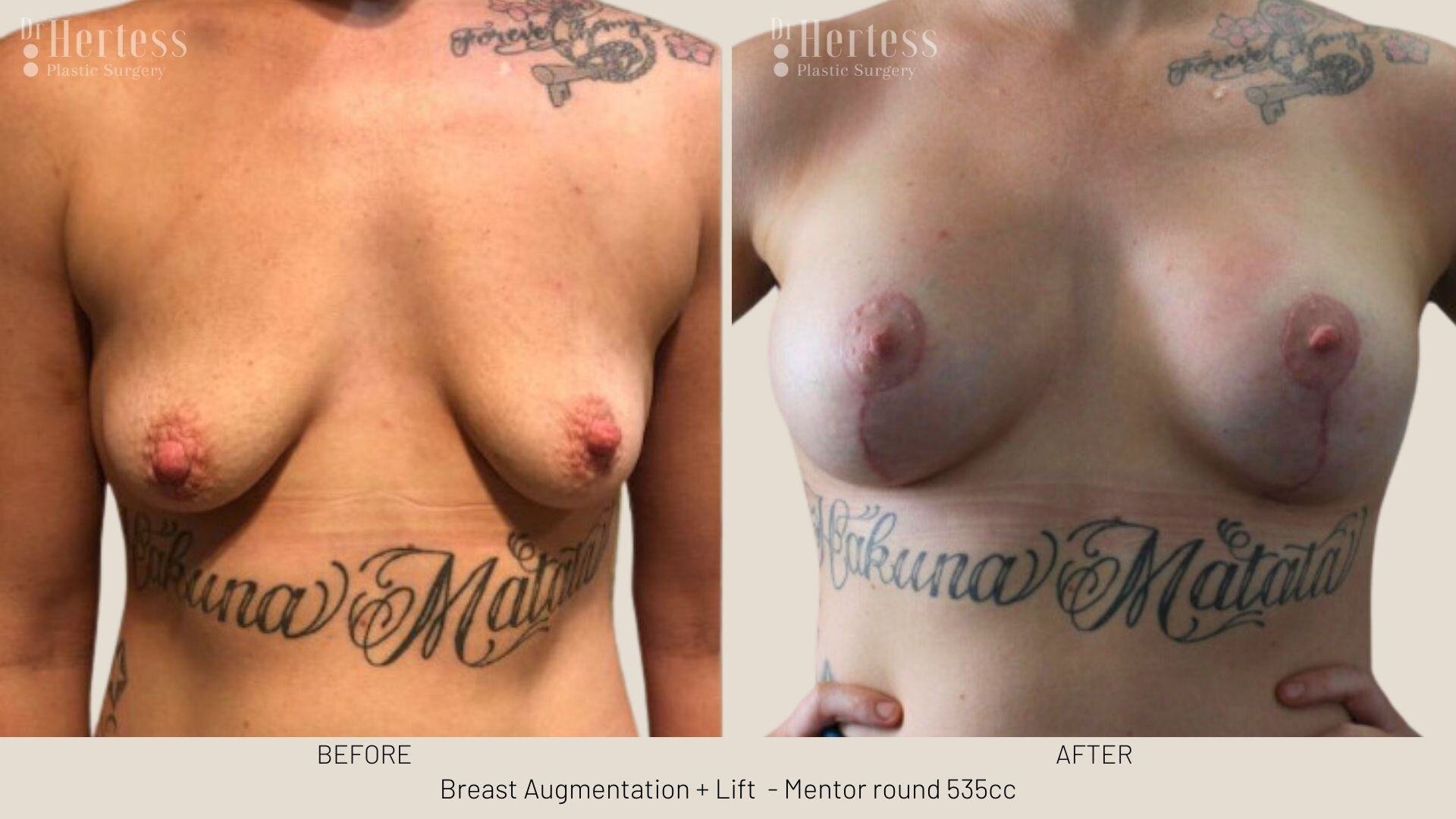 breast implants and lift photos before and after