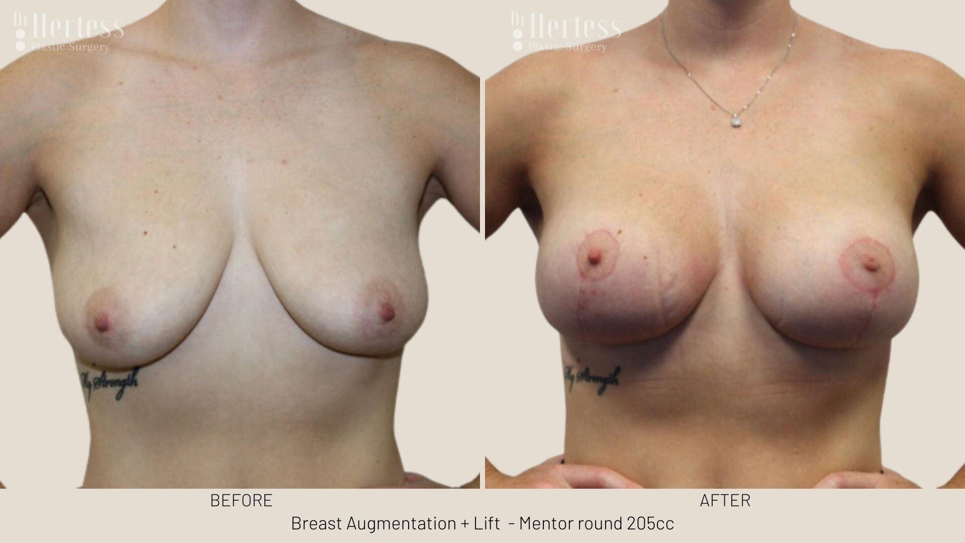 breast implants and lift photos before and after