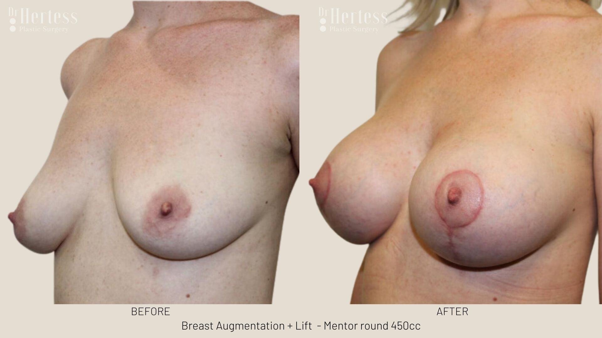 breast implants and lift photos before and after