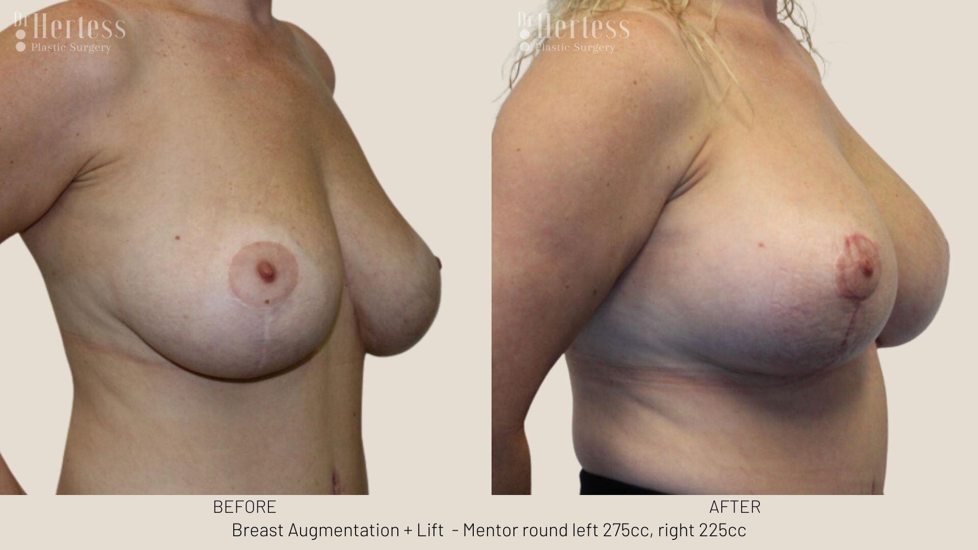 breast implants and lift photos before and after