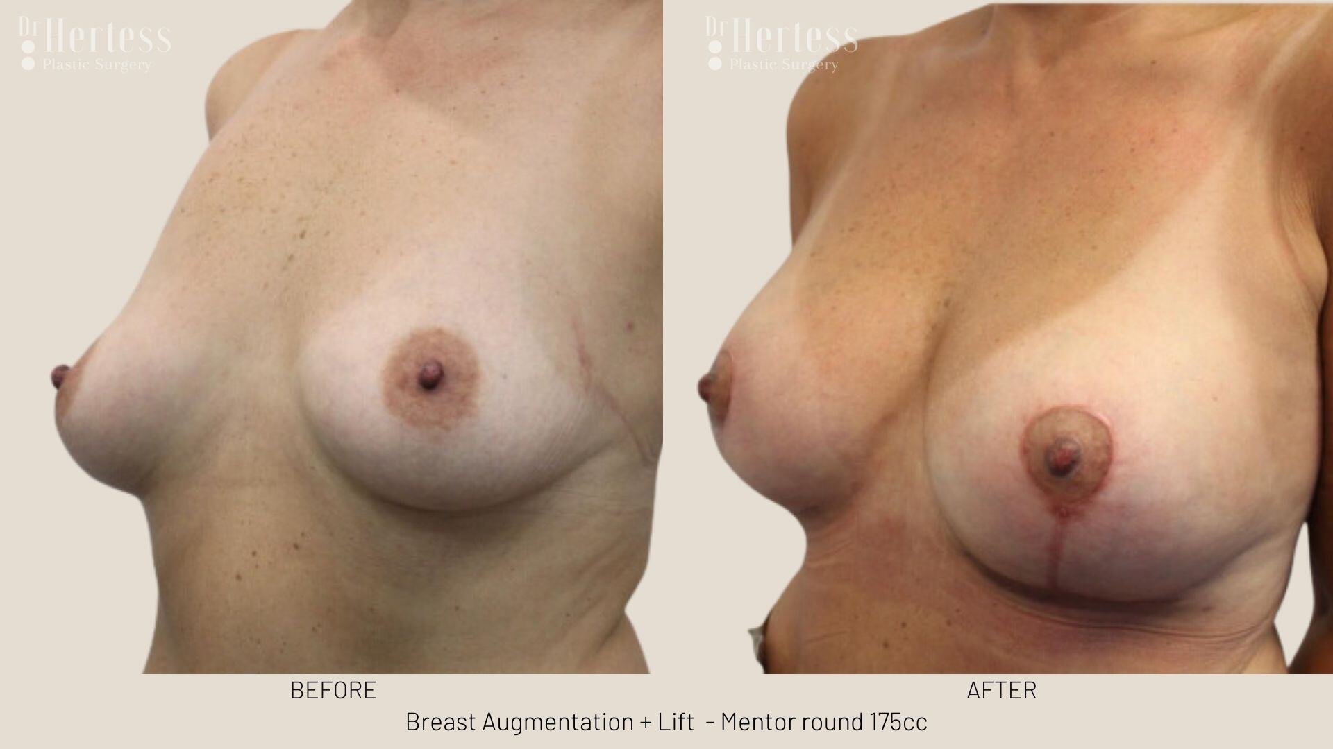 breast implants and lift photos before and after