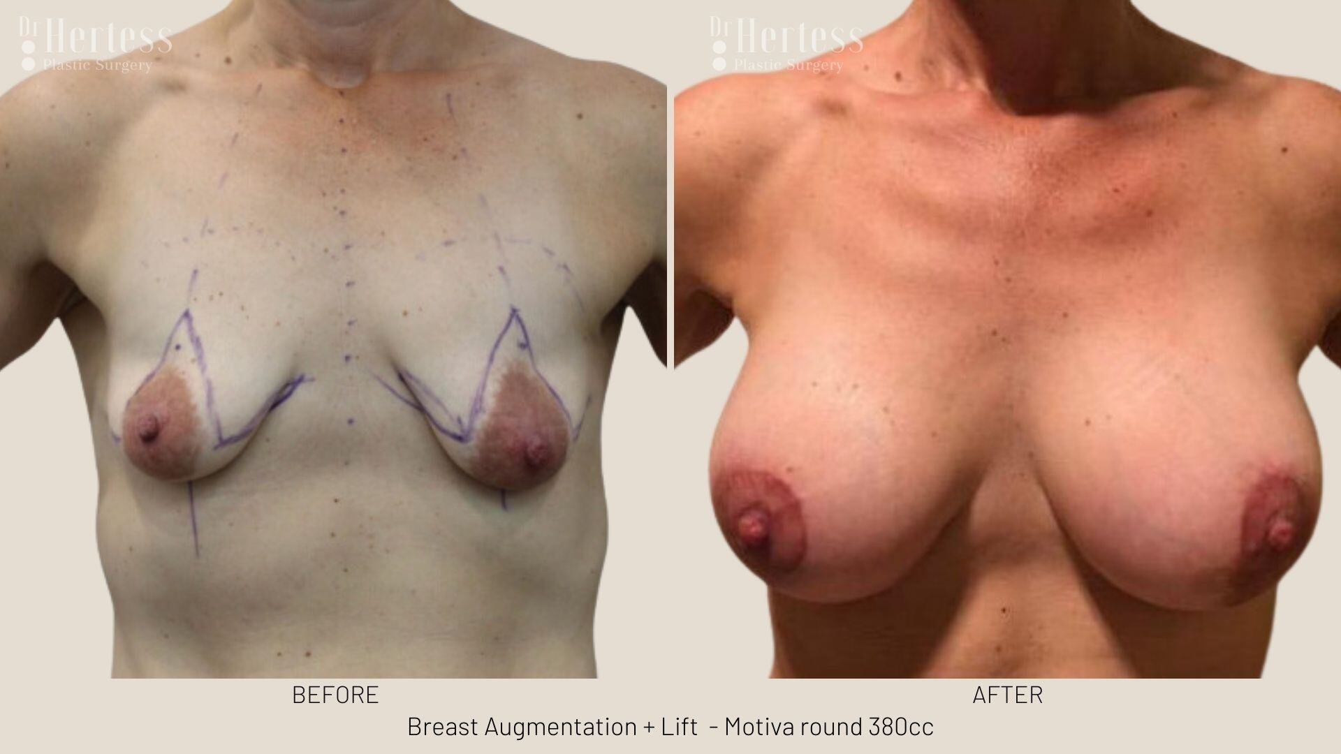 breast implants and lift photos before and after