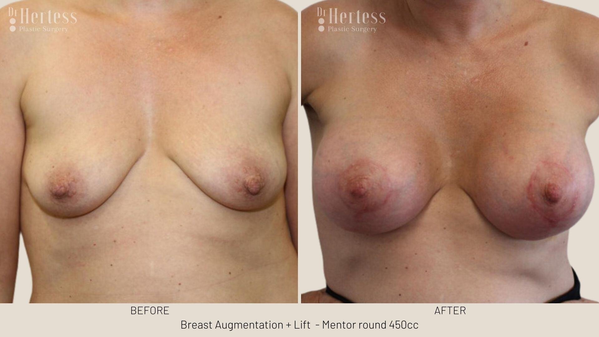 breast implants and lift photos before and after