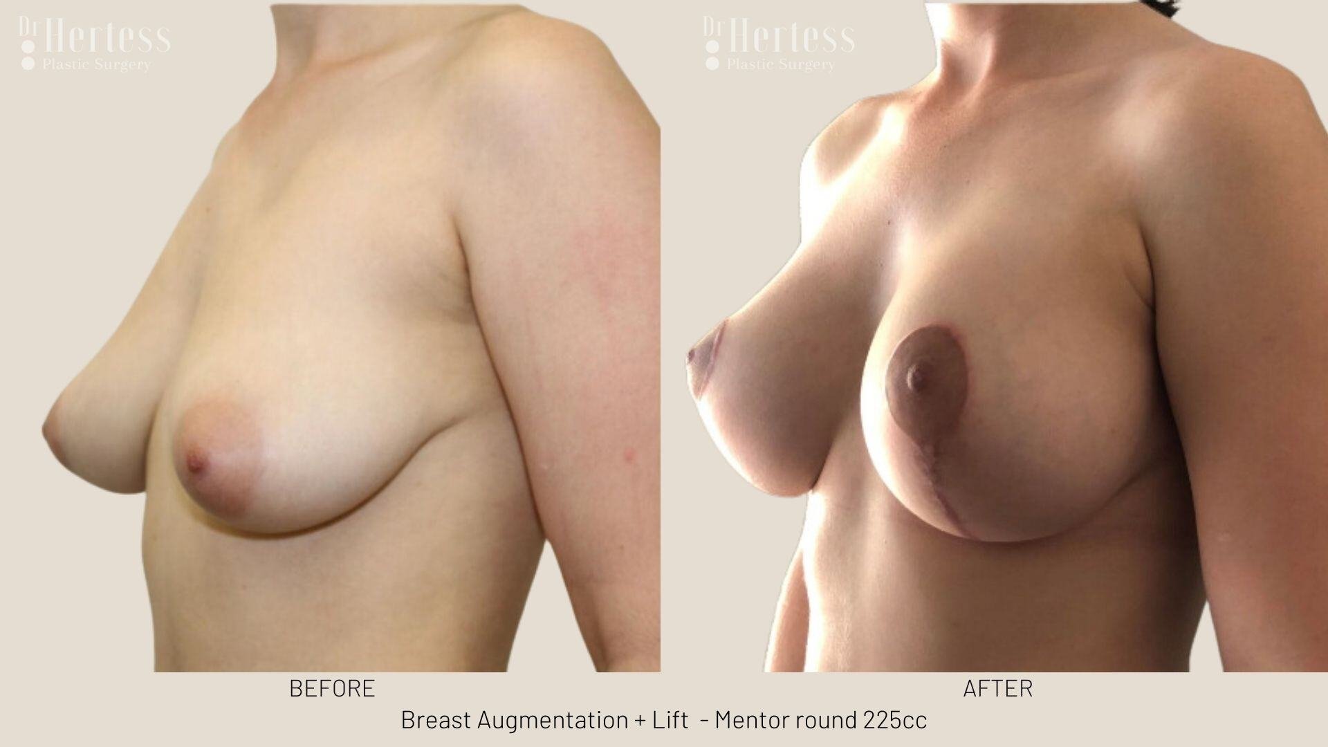 breast implants and lift photos before and after