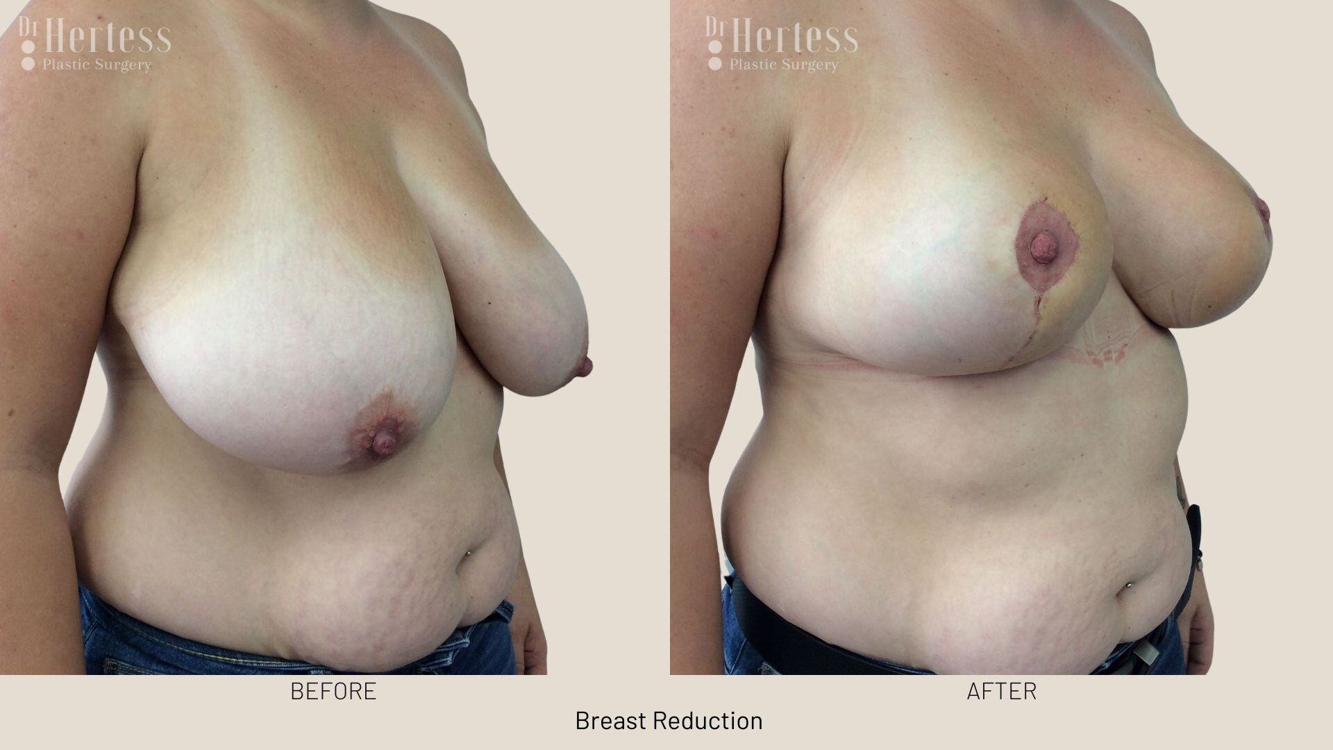 breast reduction before and after