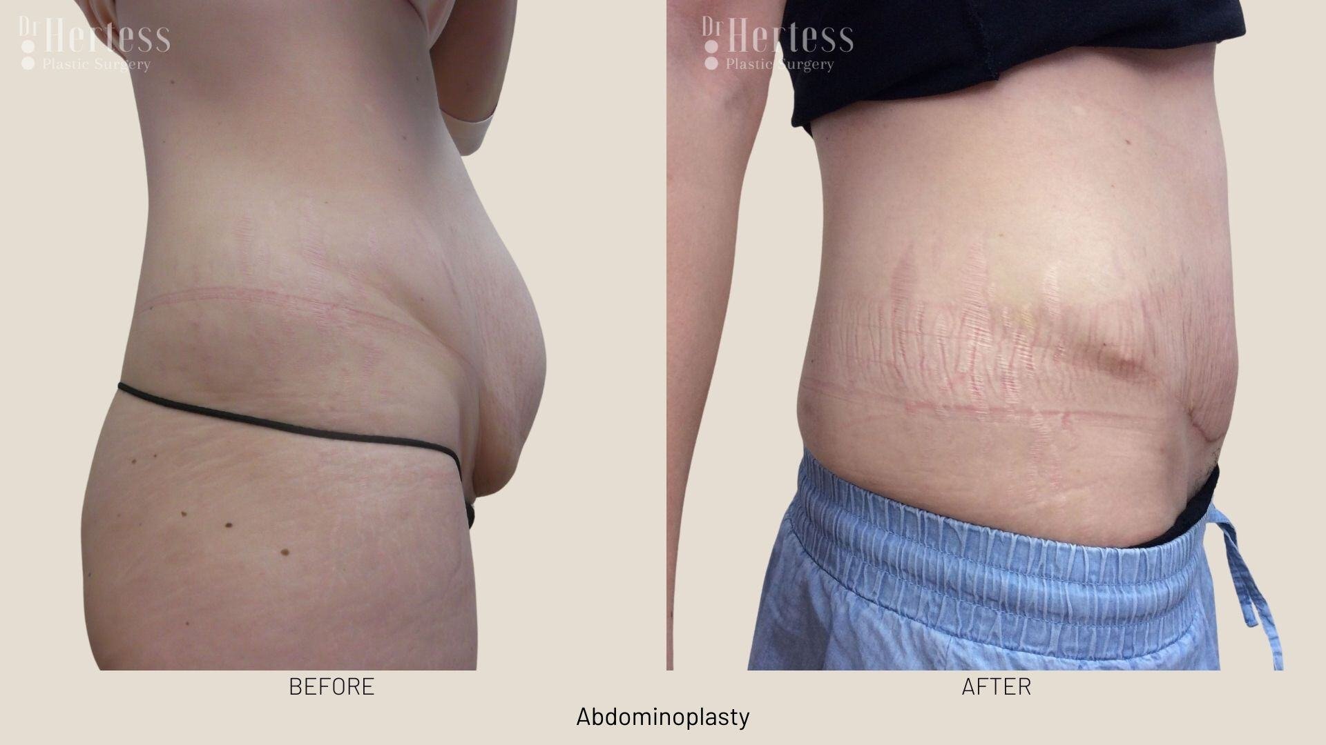 abdominoplasty before and after photos