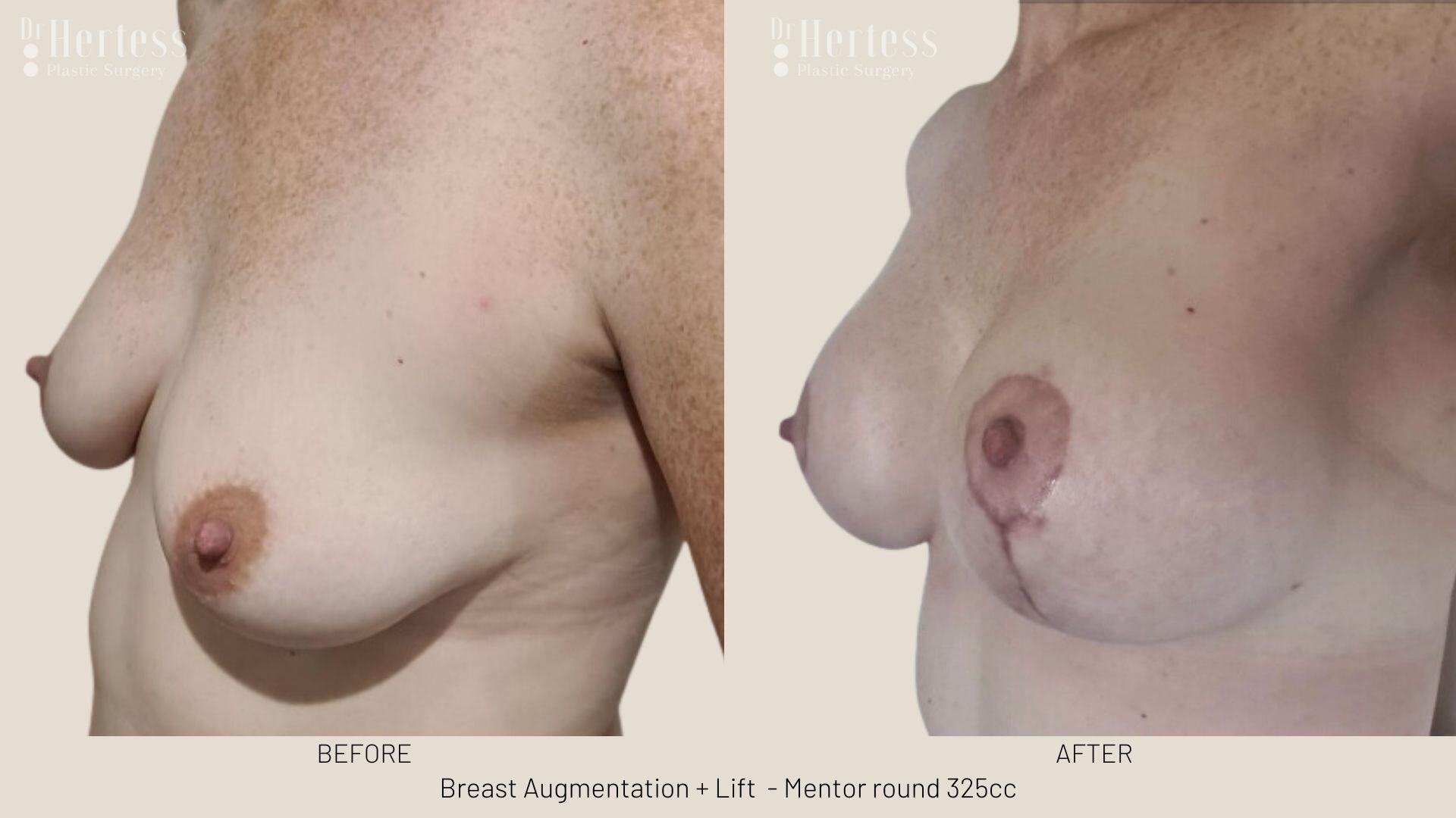 breast implants and lift photos before and after