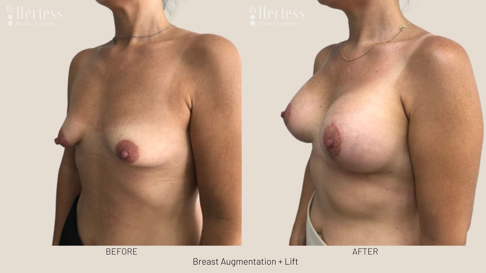 implants and lift photos before and after