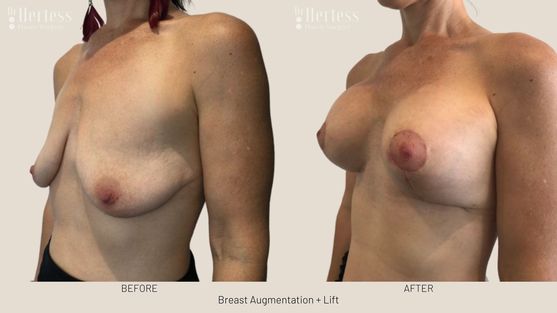 implants and lift photos before and after