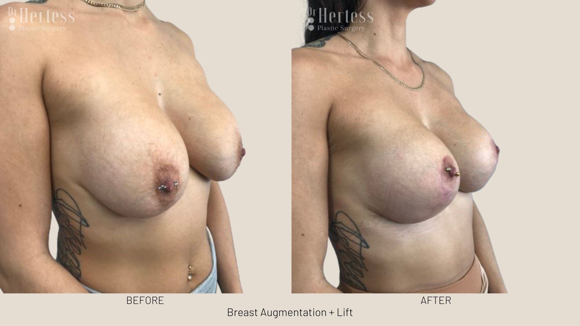 implants and lift photos before and after