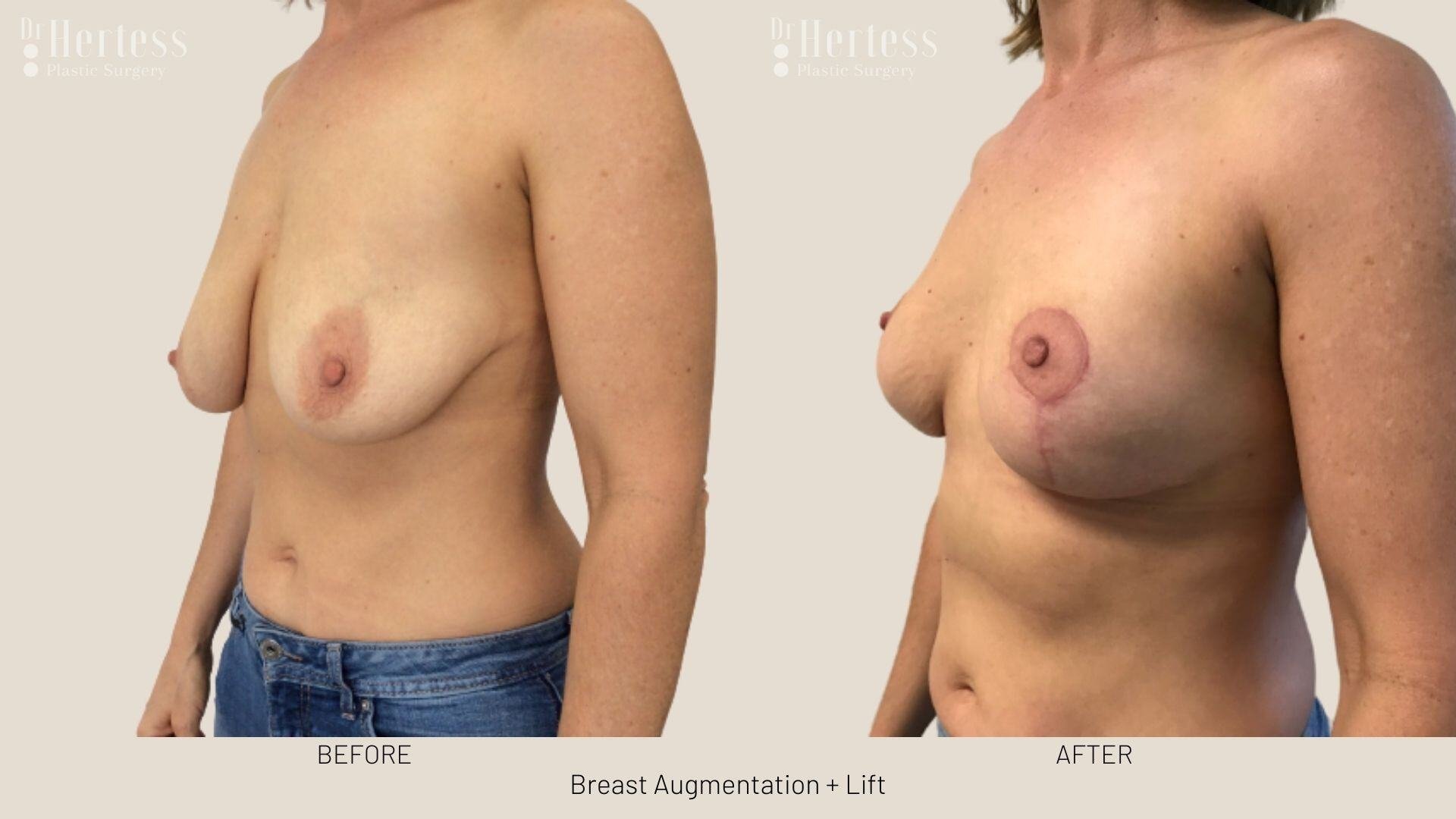 implants and lift photos before and after