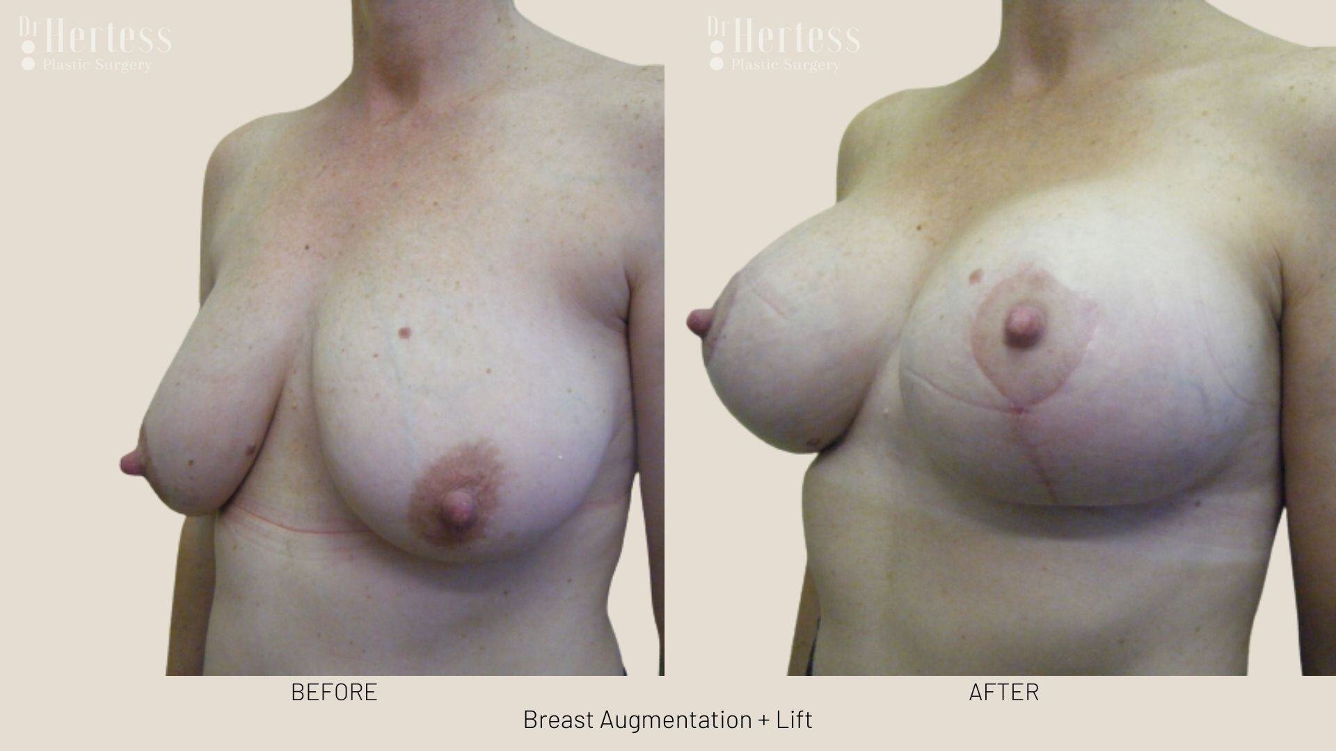 implants and lift photos before and after