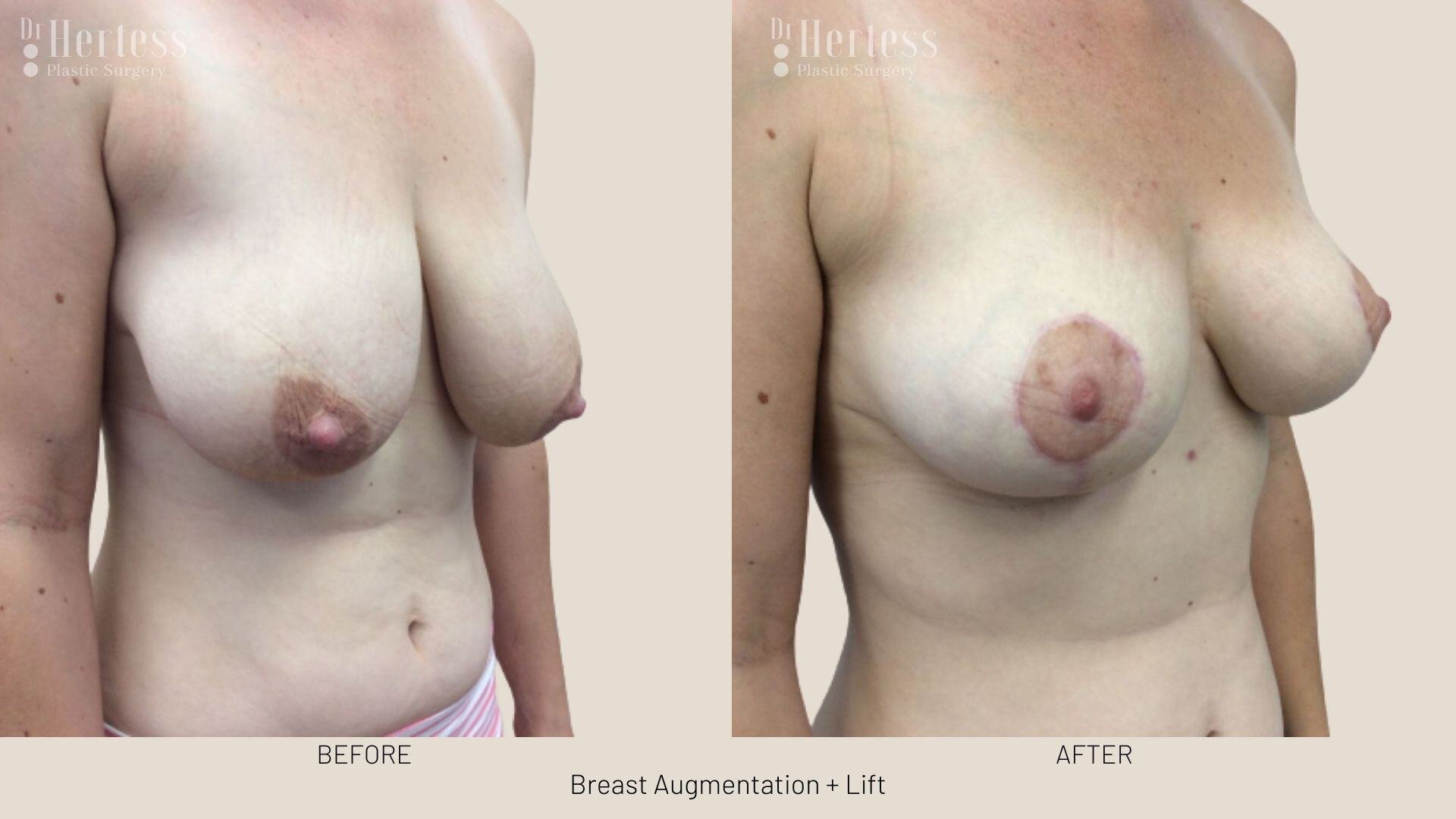 implants and lift photos before and after