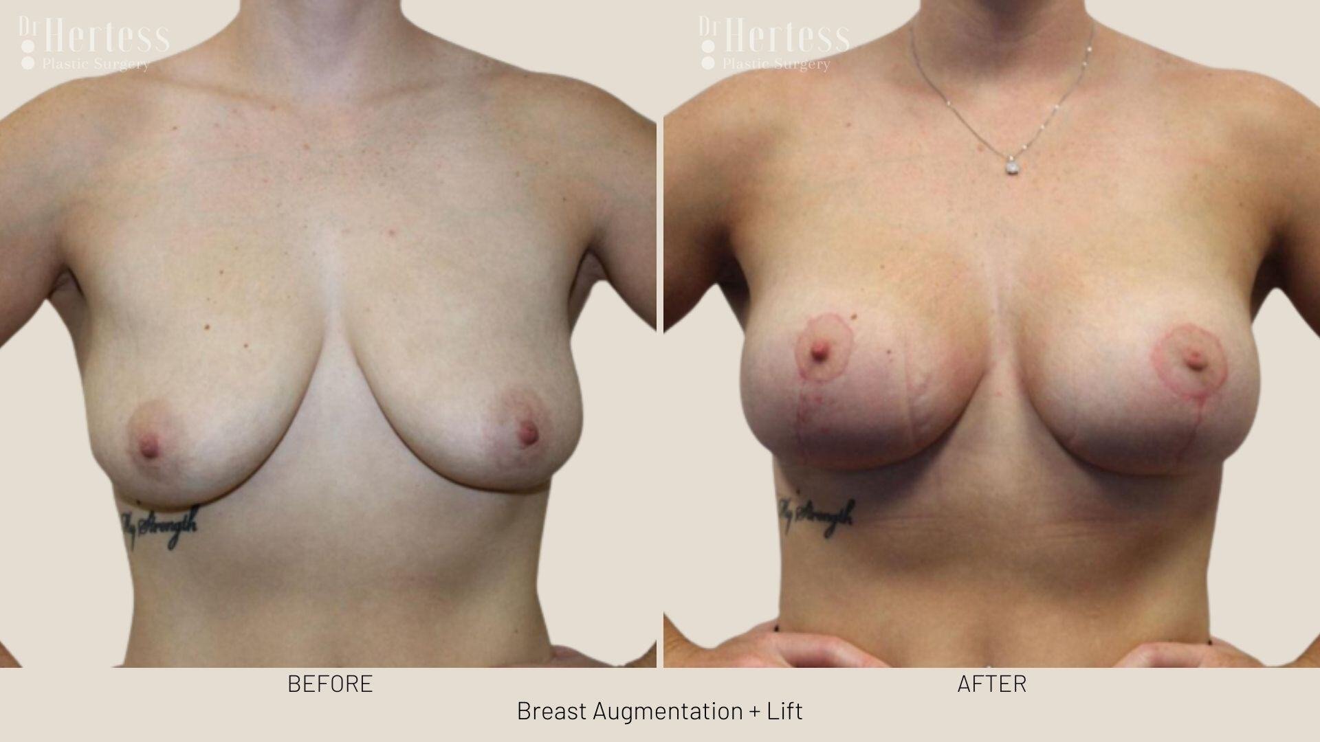 implants and lift photos before and after