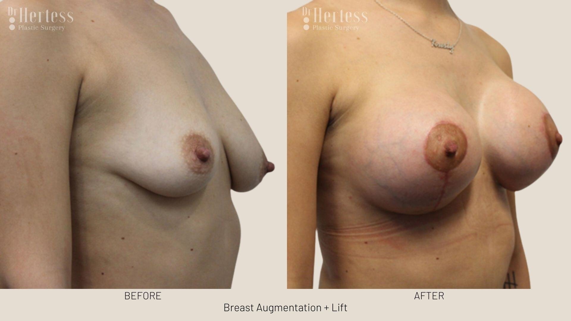 implants and lift photos before and after