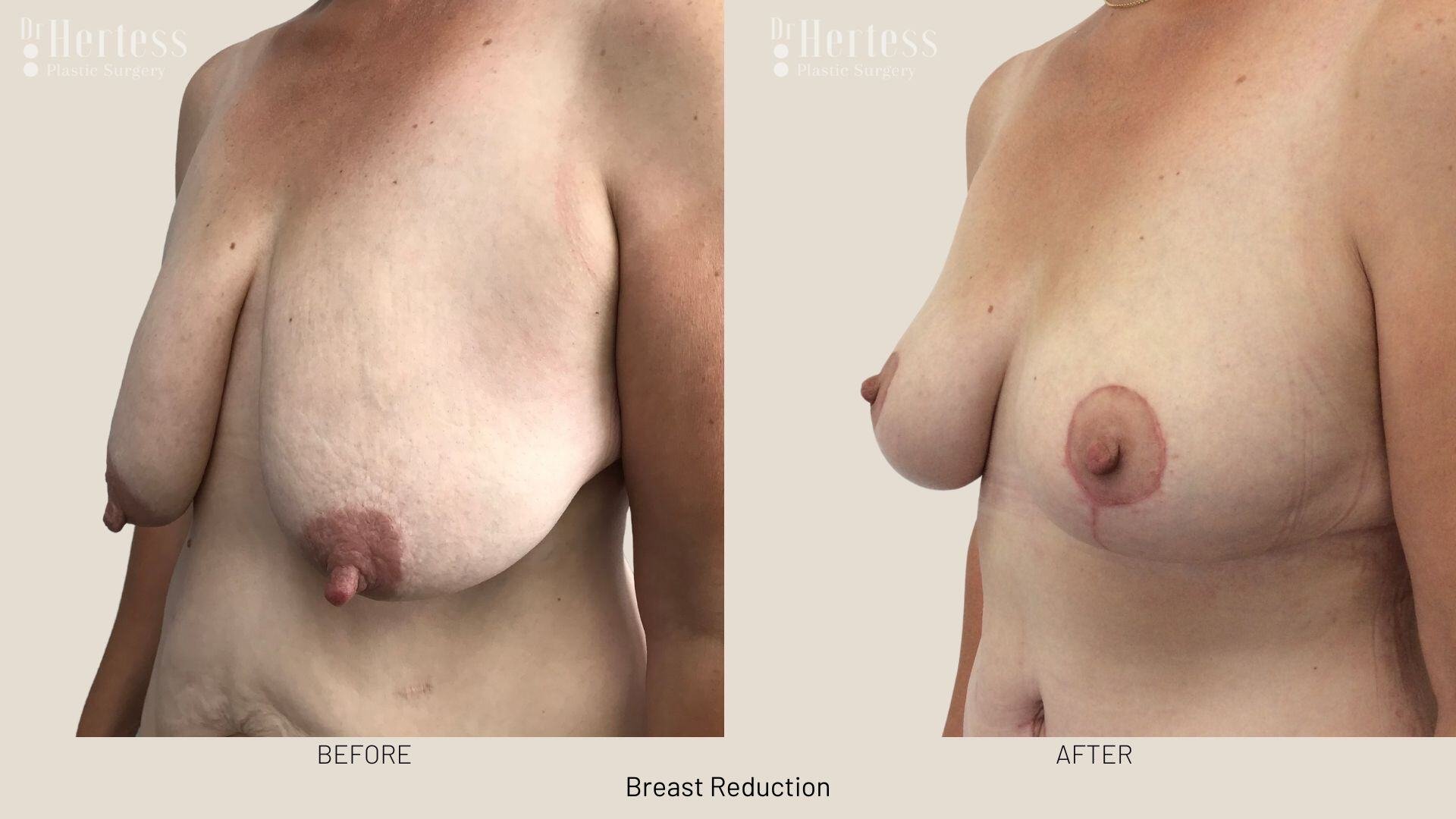 breast reduction before and after