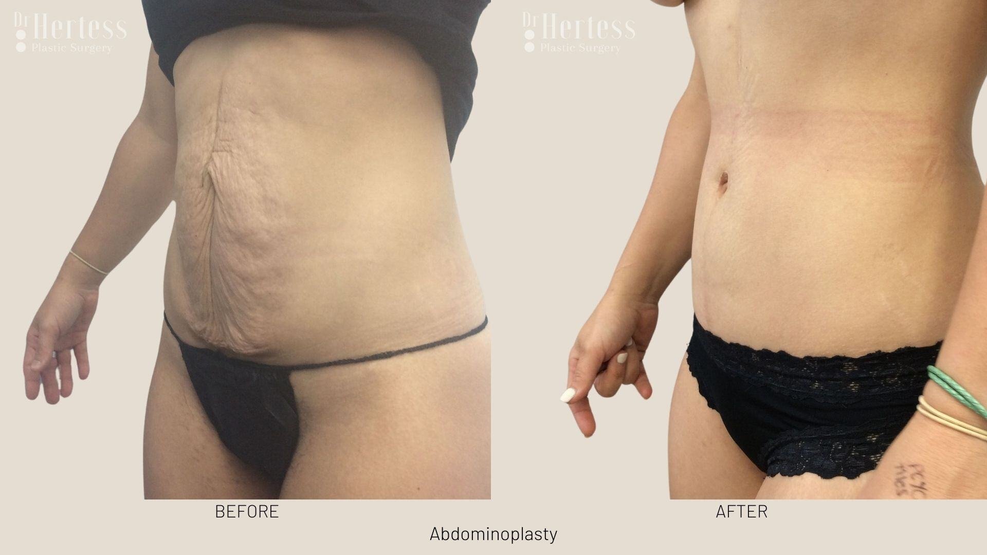 abdominoplasty before and after photos