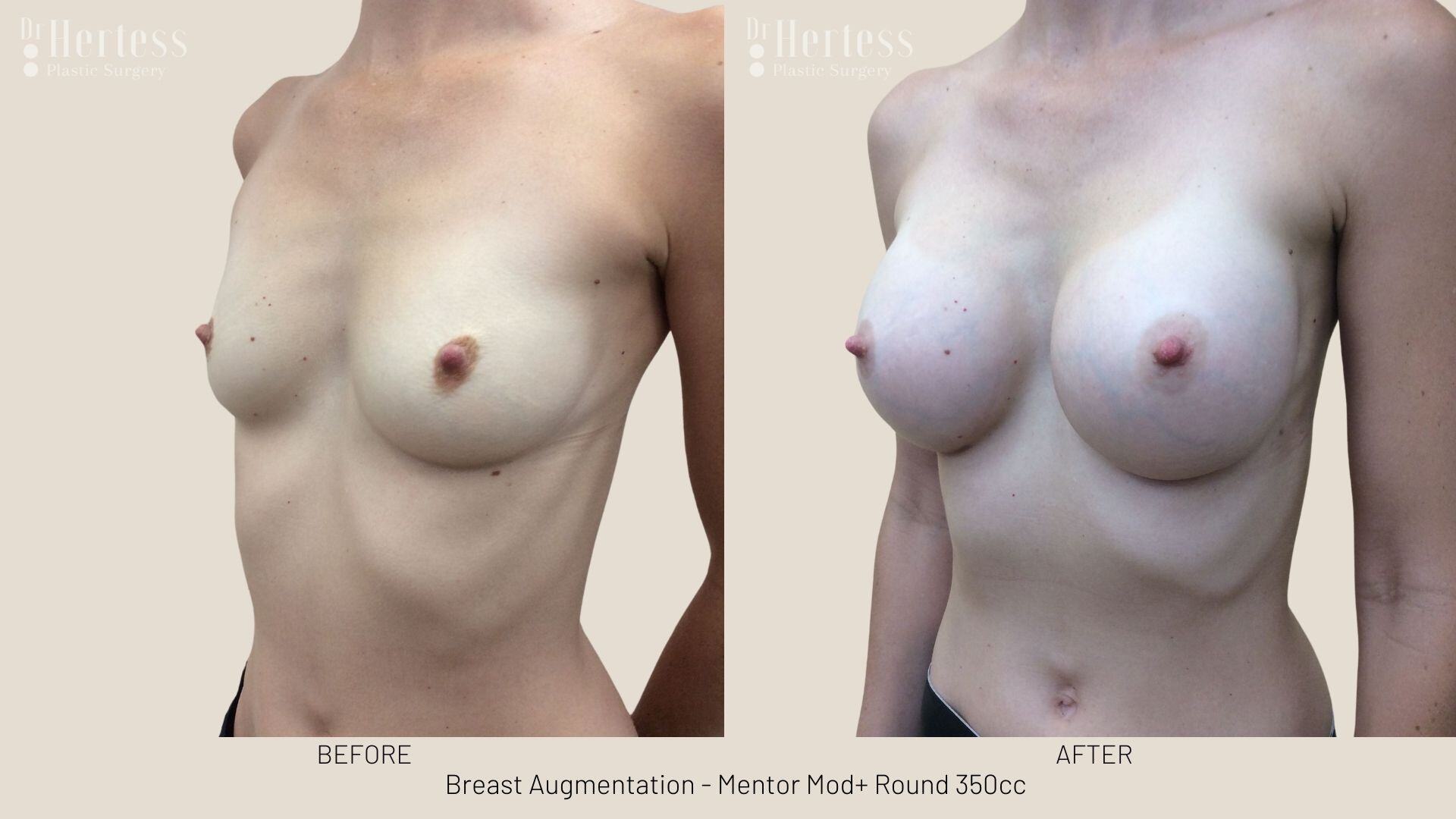 breast implants before and after
