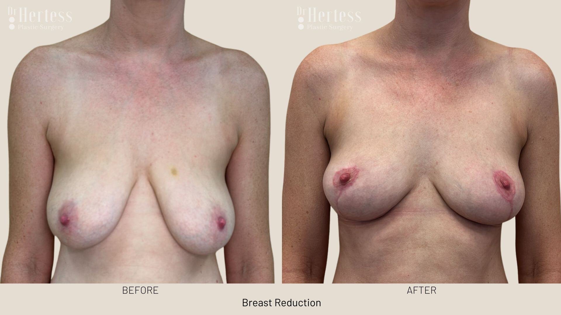 breast reduction before and after