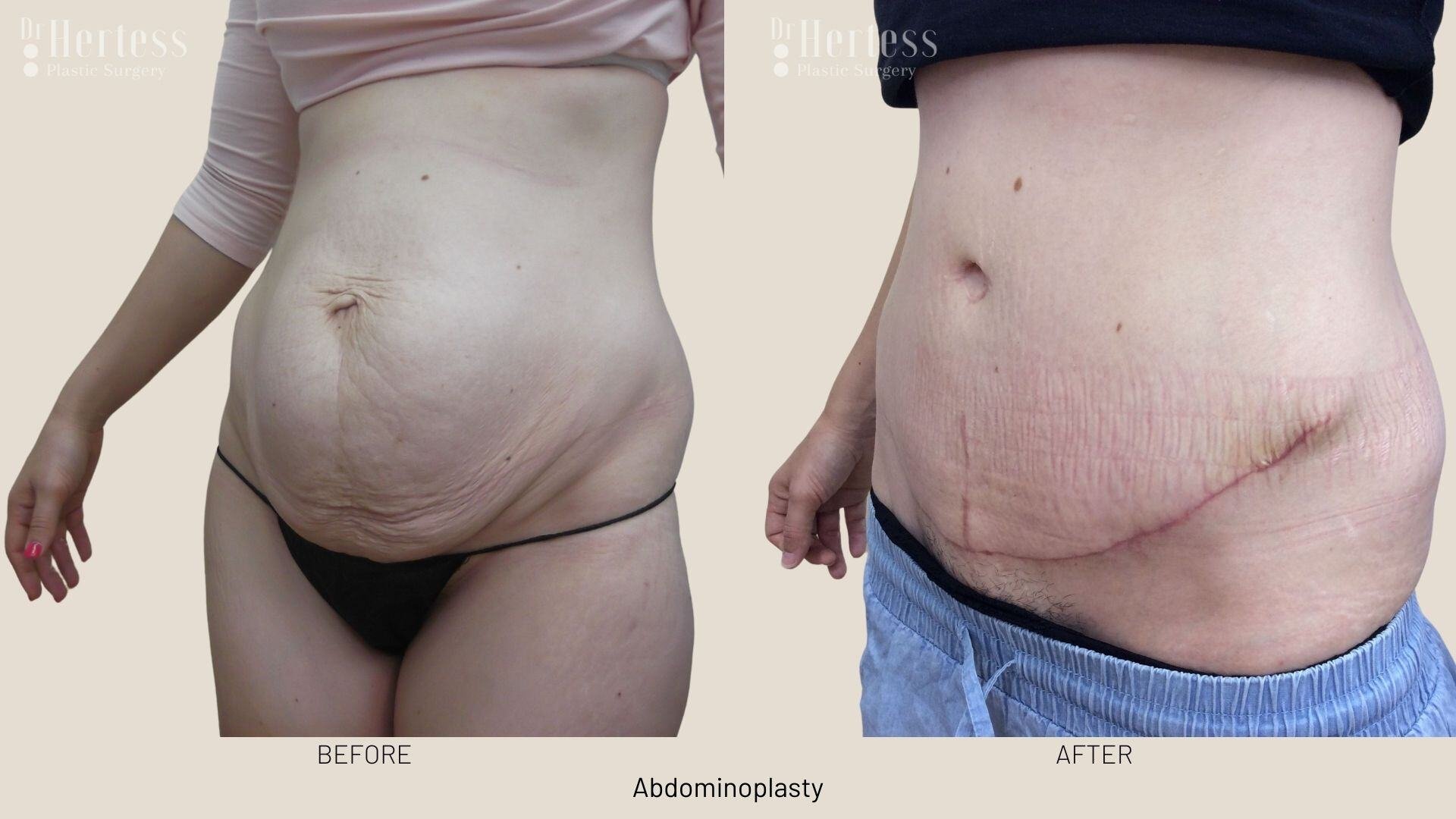abdominoplasty before and after photos
