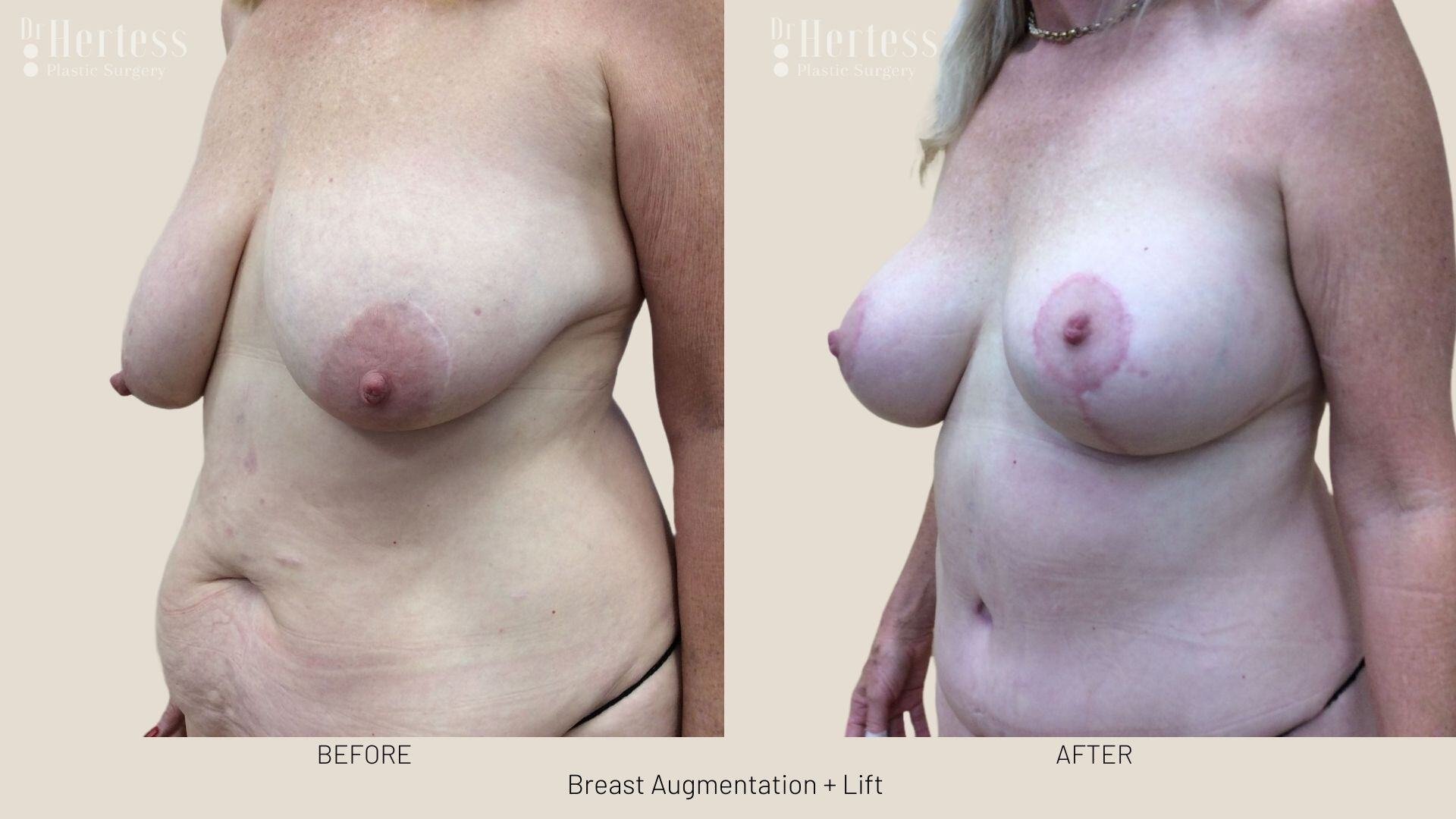 implants and lift photos before and after