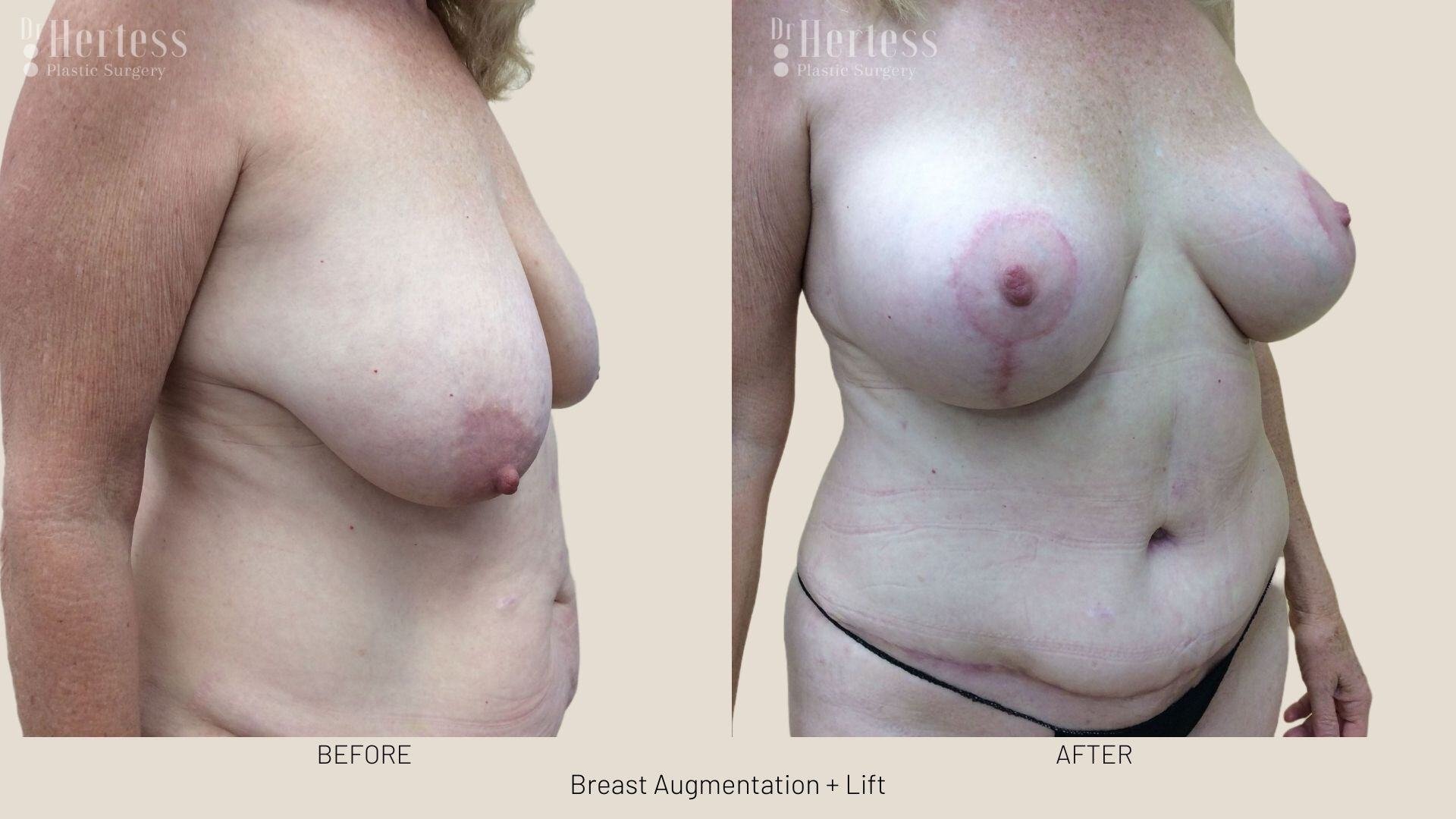 implants and lift photos before and after