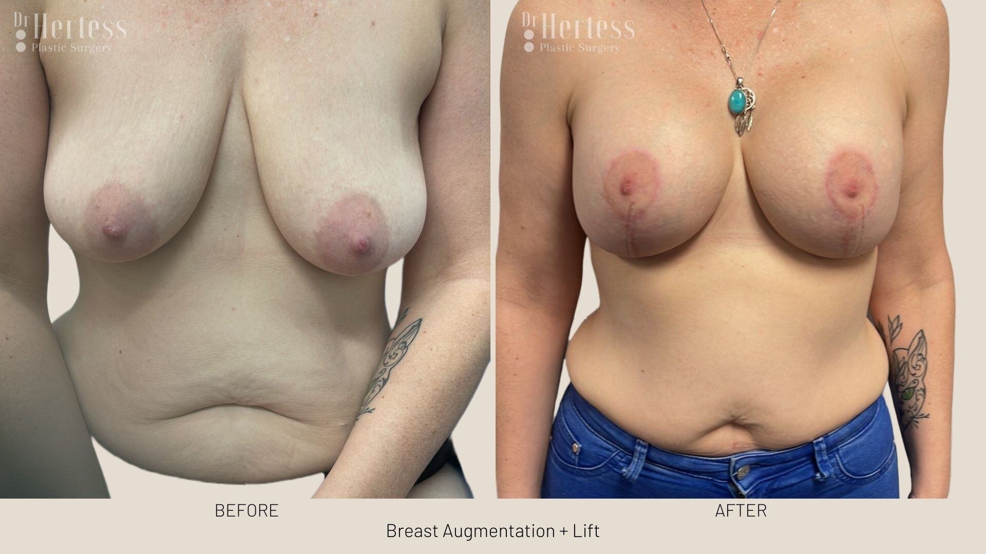 implants and lift photos before and after