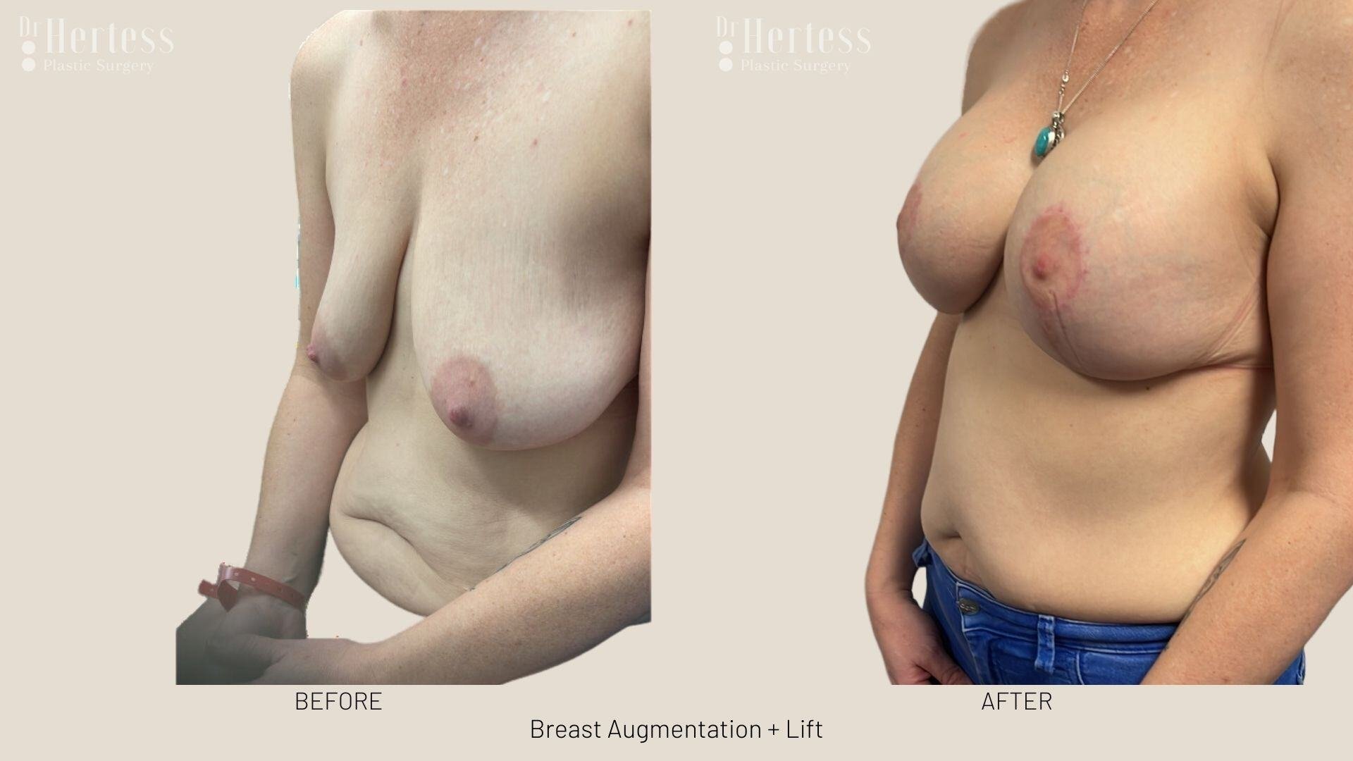 implants and lift photos before and after