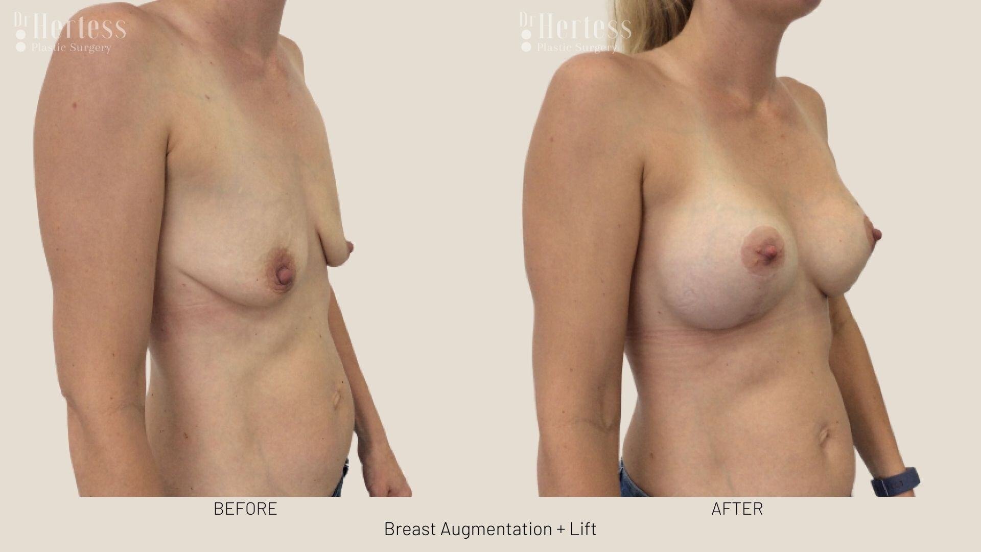 implants and lift photos before and after
