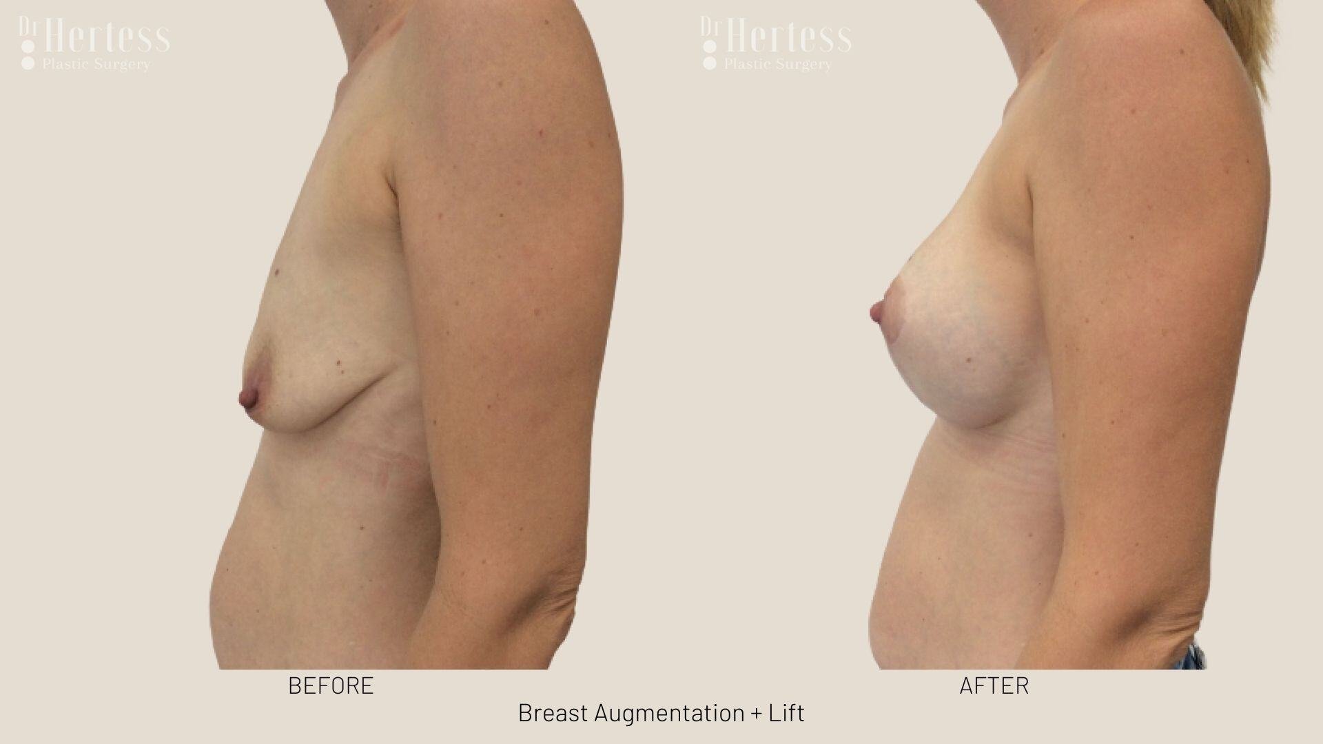 implants and lift before and after