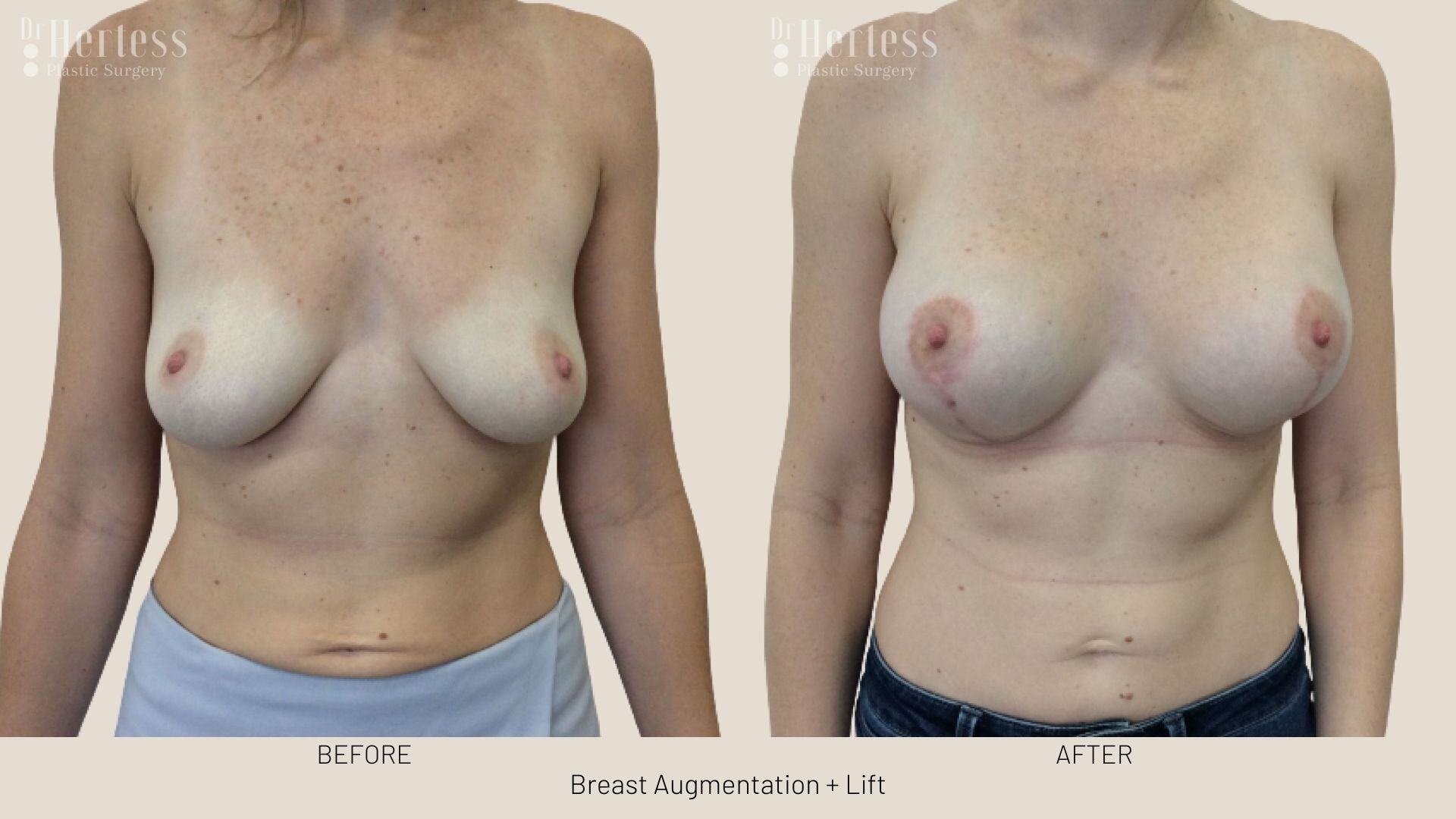 implants and lift before and after