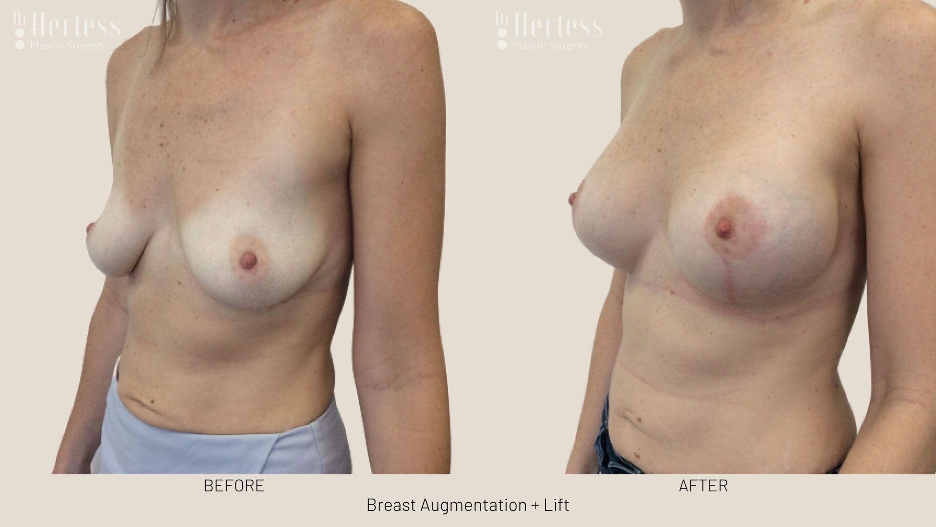 implants and lift before and after