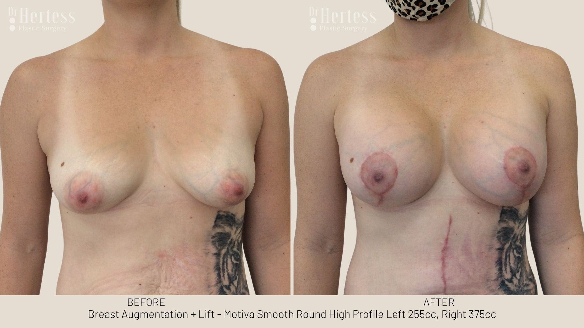 implants and lift before and after