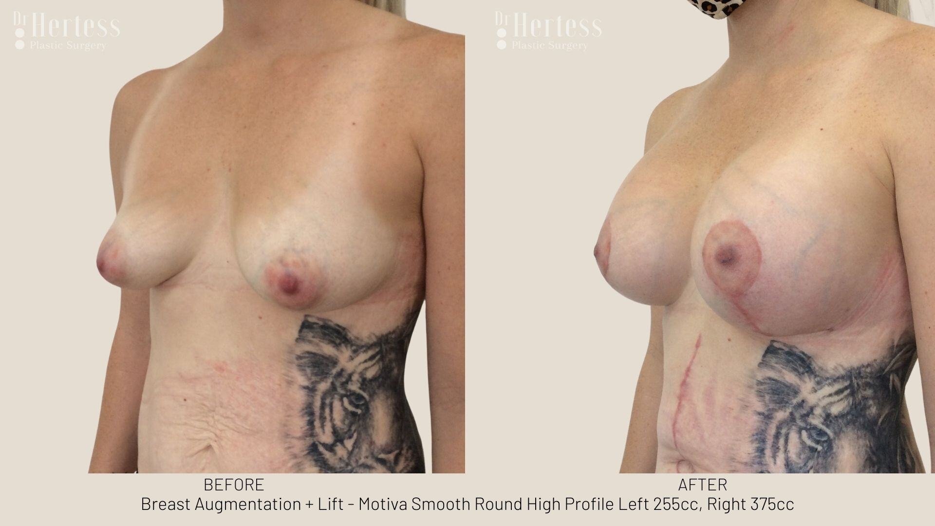 implants and lift before and after