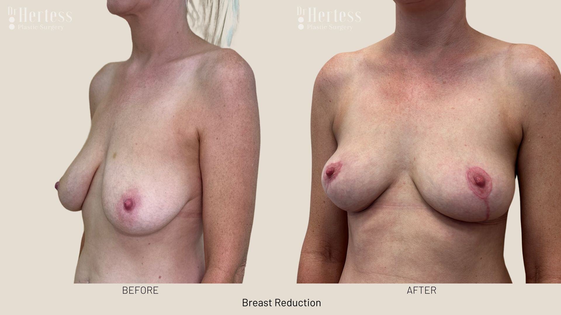 breast reduction before and after