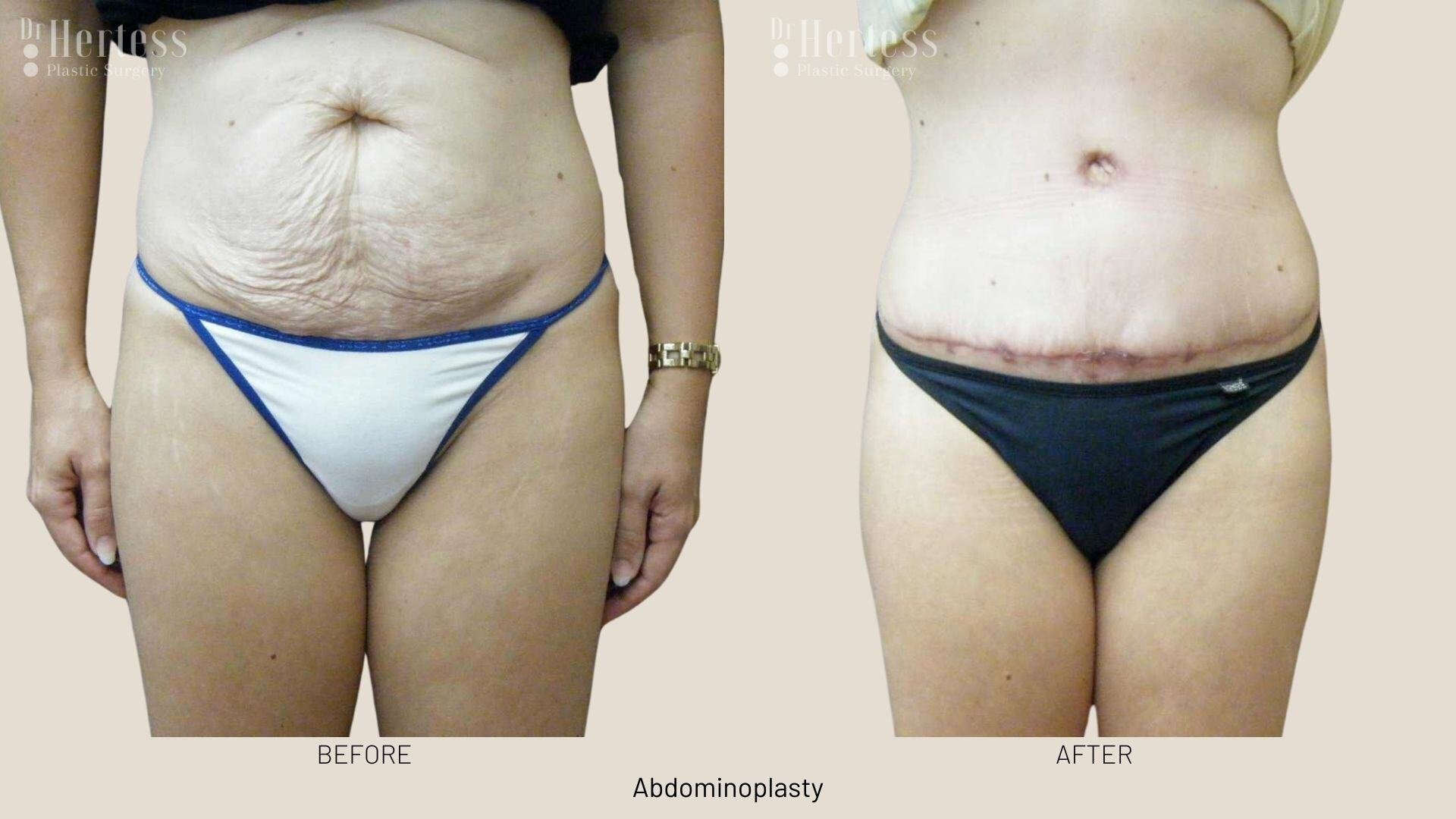 abdominoplasty before and after photos