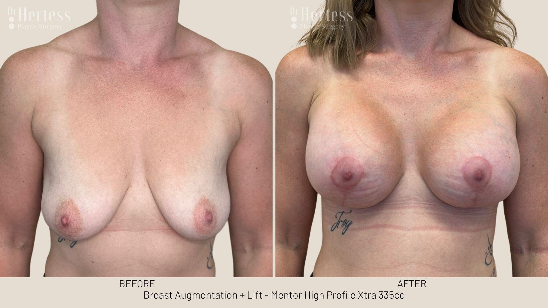 implants and lift before and after