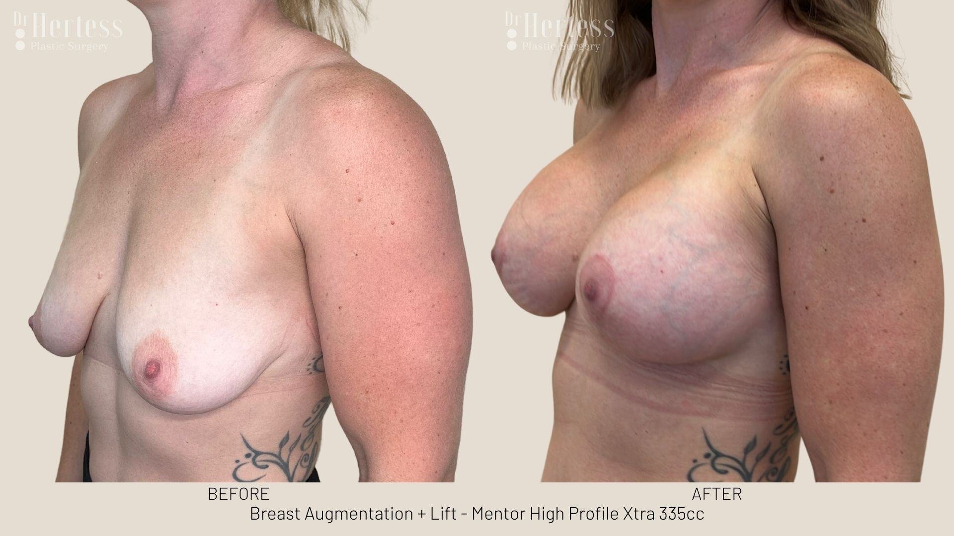 implants and lift before and after