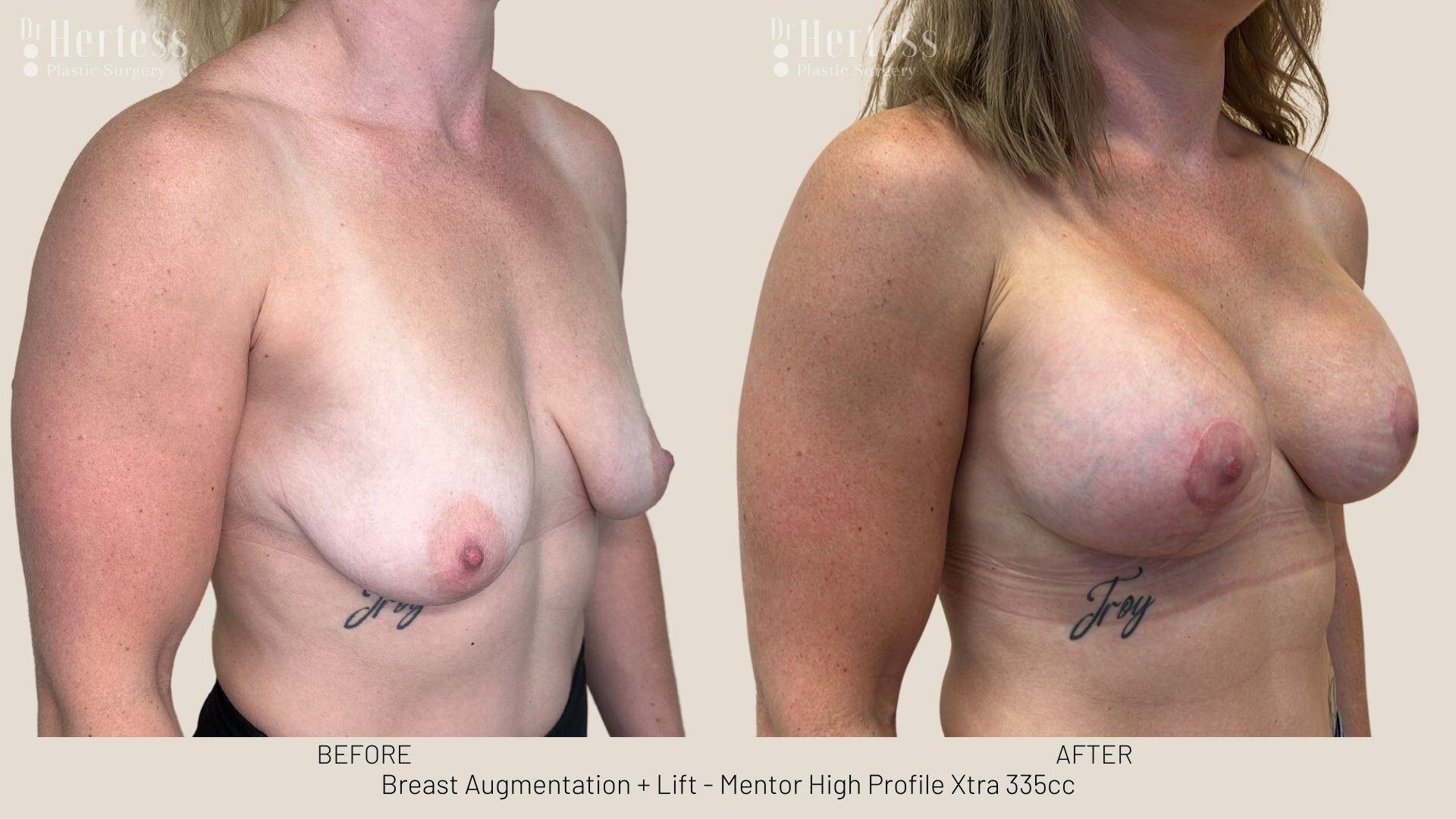 implants and lift before and after