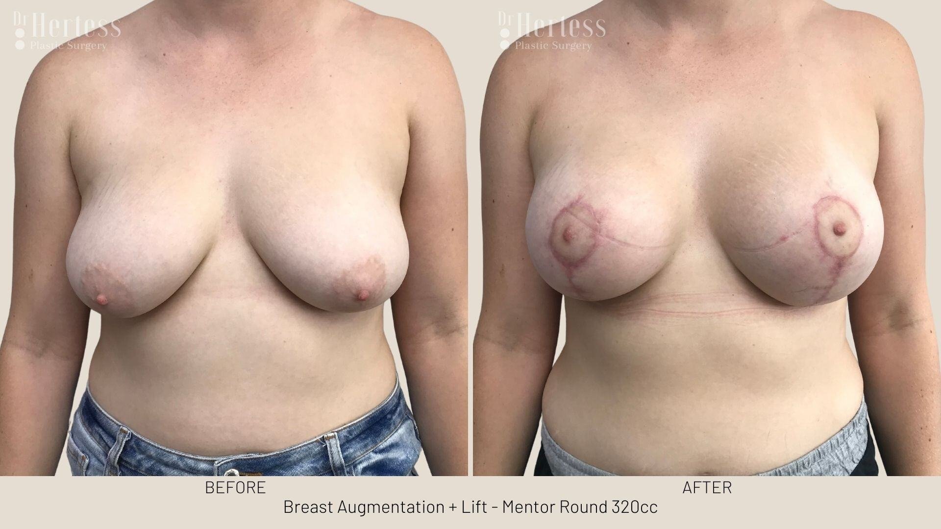 implants and lift before and after