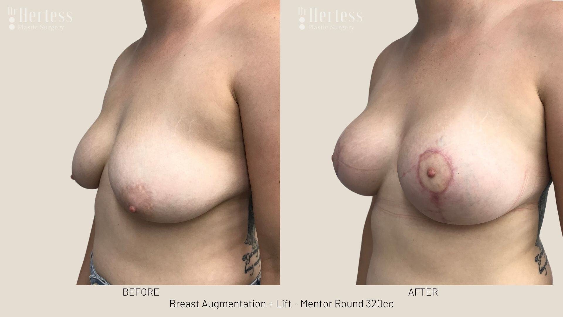 implants and lift before and after