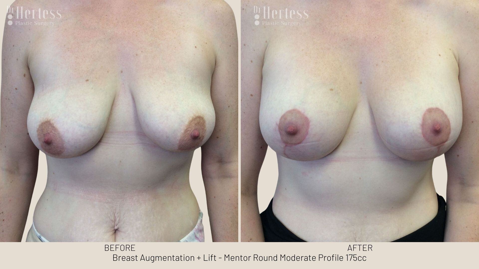 implants and lift before and after