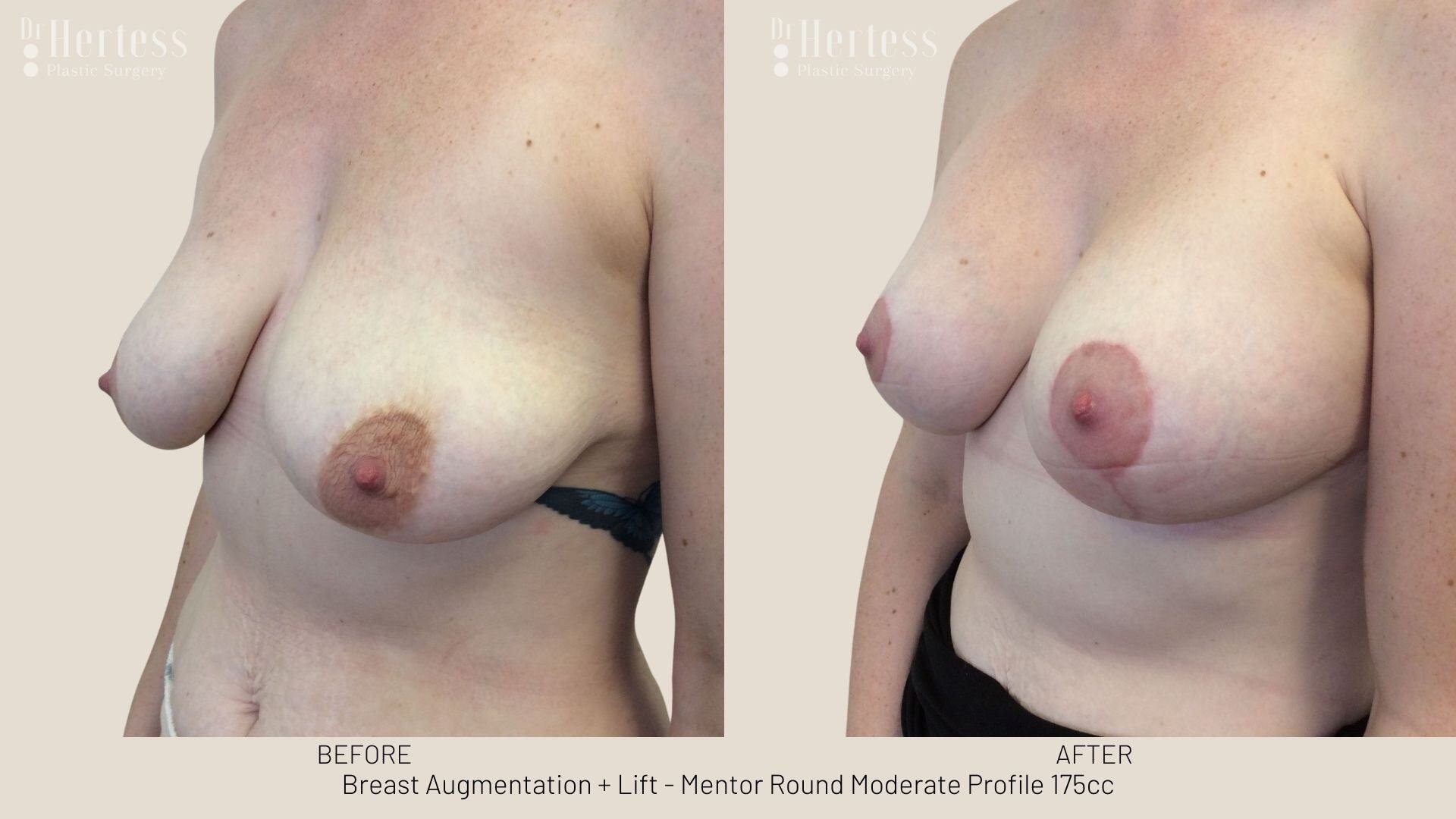 implants and lift before and after