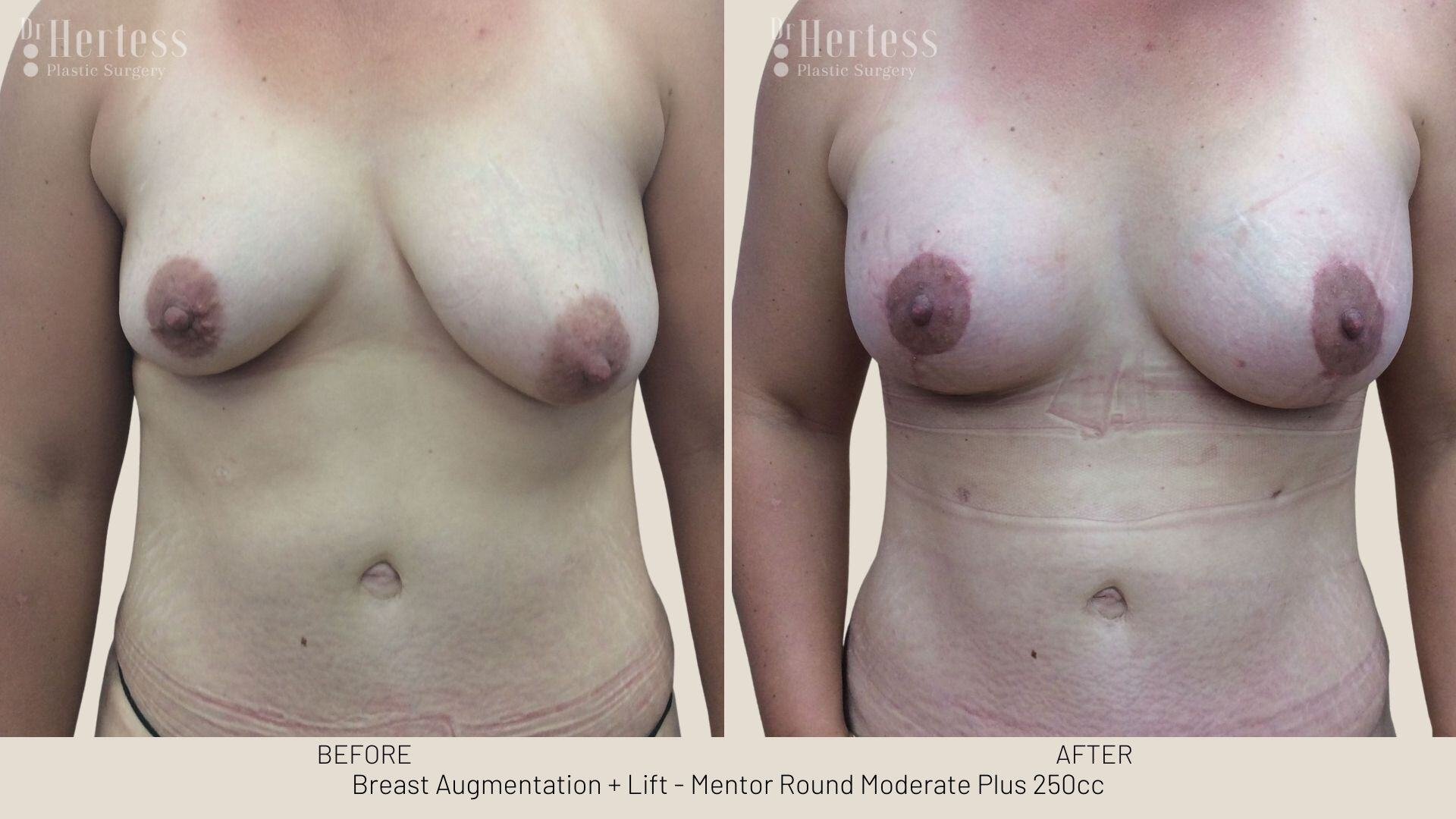 implants and lift before and after